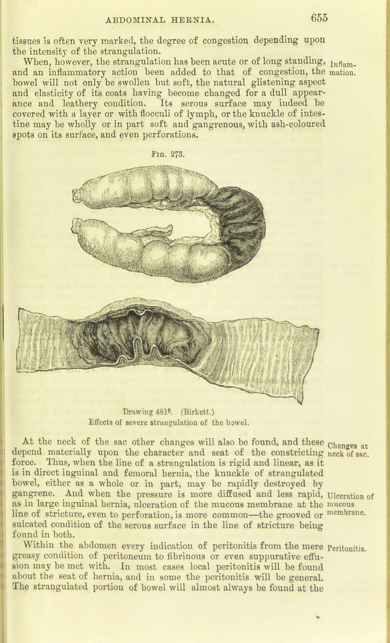 tissues is often very marked, the degree of congestion depending upon the intensity of the strangulation. When, however, the strangulation has been acute or of long standing, and an inflammatory action been added to that of congestion, the mation. bowel will not only be swollen but soft, the natural glistening aspect and elasticity of its coats having become changed for a dull appear- ance and leathery condition. Its serous surface may indeed be covered with a layer or with flocculi of lymph, or the knuckle of intes- tine may be wholly or in part soft and gangrenous, with ash-coloured spots on its surface, and even perforations. Fig. 273. Drawing 481*. (Birkett.) Effects of severe strangulation of the bowel. ILt At the neck of the sac other changes will also be found, and these changes at depend materially upon the character and seat of the constricting neck of sac. force. Thus, when the line of a strangulation is rigid and linear, as it is in direct inguinal and femoral hernia, the knuckle of strangulated bowel, either as a whole or in part, may be rapidly destroyed by gangrene. And when the pressure is more diffused and less rapid. Ulceration of as in large inguinal hernia, ulceration of the mucous membrane at the mucous line of stricture, even to perforation, is more common—the grooved or “>*mbrane. sulcated condition of the serous surface in the line of stricture being found in both. Within the abdomen every indication of peritonitis from the mere Peritonitis, tj greasy condition of peritoneum to fibrinous or even suppurative effu- I sion may be met with. In most cases local peritonitis will be found about the seat of hernia, and in some the peritonitis will be general, w The strangulated portion of bowel will almost always be found at the 1.