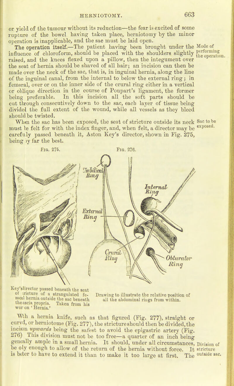 r or yield of the tumour without its reduction—the fear is excited of some j rupture of the bowel having^ taken place, herniotomy by the minor ( operation is inapplicable, and the sac must be laid open. The operation itself.—The patient having been brought under the Mode of I influence of chloroform, should be placed with the shoulders slightly ^“atfon i raised, and the knees flexed upon a pillow, then the integument over » the seat of hernia should be shaved of all hair; an incision can then be 1 made over the neck of the sac, that is, in inguinal hernia, along the line ' of the inguinal canal, from the internal to below the external ring; in |i femoral, over or on the inner side of the crural ring either in a vertical ; or olilique direction in the course of Poupart’s ligament, the former ; being preferable. In this incision all the soft parts should be 1 cut tk'ough consecutively down to the sac, each layer of tissue bemg dividel the full extent of the wound, while aU vessels as they bleed ! should be twisted. Wbm the sac has been exposed, the seat of stricture outside its neck Sac to be t must le felt for with the index finger, and, when felt, a director may be [■ carefuly passed beneath it, Aston Key’s director, shown in Fig. 275, I being >y far the best. Fig. 276. Fig. 276. il Key’siirector passed beneath the seat ot irieture of a strangulated fe- Drawing to illustrate the relative position of moil liernia outside the sac beneath all the abdominal rings from uithin. the aseia propria. Taken from his wor on ‘ Hernia.’ Wth a hernia knife, such as that figured (Fig. 277), straight or ! curvd, or herniotome (Fig. 277), the stricture should then be divided, the I incism upwards being the safest to avoid the epigastric artery (Fig. 276) This division must not be too free—a quarter of an inch being ’ gencally ample in a small heniia. It should, under all circumstances. Division of 1 be oly enough to allow of the return of the hernia without force. It stricture I is biter to have to extend it than to make it too large at first. The