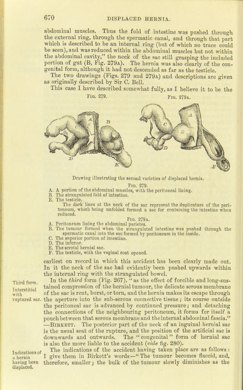 abdominal muscles. Thus the fold of intestine was pushed through the external ring, through the spermatic canal, and through that part which is described to be an internal ring (but of which no trace could be seen), and was reduced within the abdominal muscles but not within the abdominal cavity,” the neck of the sac still grasping the included portion of gut (B, Fig. 279a). The hernia was also clearly of the con- genital form, although it had not descended as far as the testicle. The two drawings (Figs. 279 and 279a) and descriptions are given as originally described by Sir C. Bell. This case I have described somewhat fully, as I believe it to be the Fig- 279. Fiq. 279a. Drawing illustrating the second varieties of displaced hernia. Fig. 279. A. A portion of the abdominal mnscles, with the peritoneal lining. B. The strangulated fold of intestine. E. The testicle. The dark lines at the neck of the sac represent the duplicature of the peri- toneum, which being unfolded formed a sac for containing the intestine when reduced. Fig. 279a. A. Peritoneum lining the abdominal parietes. B. The tumour formed when the strangulated intestine was pushed through the spermatic canal into the sac formed by peritoneum in tlie inside. C. The snperior portion of intestine. D. The inferior. E. The scrotal hernial sac. F. The testicle, with the vaginal coat opened. earliest on record in which this accident has been clearly made out. In it the neck of the sac had evidently been pushed upwards within the internal ring with the strangulated howel. Third form. third form (Fig. 267), “as the effect of forcible and long-sus- Interstitial compression of the hernial tumour, the delicate serous membrane with of tliG sac is rent, burst, or torn, and the hernia makes its escape through ruptured sac. the aperture into the sub-serous connective tissue; its course outside the peritoneal sac is advanced by continued pressure; and detaching the connections of the neighbonring peritoneum, it forms for itself a pouch between that serous membrane and theinternal abdominal fascia.” —Biekbtt. The posterior part of the neck of an inguinal hernial sac is the usual seat of the rupture, and the position of the artificial sac is downwards and outwards. The “ congenital ” form of hernial sac is also the more liable to the accident {vide fig. 280). Indications of indications of the accident having taken place are as follows ; a hernia I give them in Birkett’s words—“The tumour becomes flaccid, and, having been therefore, smaller; the bulk of the tumour slowly diminishes as the displaced.
