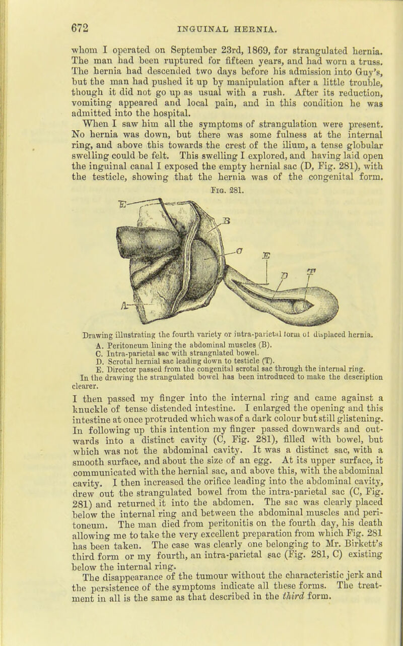 whom I operated on September 23rd, 1869, for strangulated hernia. The man had been ruptured for fifteen years, and had worn a truss. The hernia had descended two days before his admission into Guy’s, but the man had pushed it up by manipulation after a little trouble, though it did not go up as usual with a rush. After its reduction, vomiting appeared and local pain, and in this condition he was admitted into the hospital. When I saw him all the symptoms of strangulation were present. No hernia was down, but there was some fulness at the internal ring, and above this towards the crest of the ilium, a tense globular swelling eould be felt. This swelling I explored, and having laid open the inguinal canal I exposed the empty hernial sac (D, Fig. 281), with the testicle, showing that the hernia was of the congenital form. Fig. 281. Drawing illustrating the fourth variety or intra-parietiil lorui oi displaced hernia. A. Peritoneum lining the abdominal muscles (B). C. Intra-parietal sac with strangulated bowel. D. Scrotal hernial sac leading down to testicle (T). E. Director passed from the congenital scrotal sac through the internal ring. In the drawing the strangulated bowel has been introduced to make the description clearer. I then passed my finger into the internal ring and came against a knuckle of tense distended intestine. I enlarged the opening and this intestine at once protruded which was of a dark colour but still glistening. In following up this intention my finger passed downwards and out- wards into a distinct cavity (C, Fig. 281), filled with bowel, but which was not the abdominal cavity. It was a distinct sac, with a smooth surface, and about the size of an egg. At its upper surface, it communicated with the hernial sac, and above this, with the abdominal cavity. I then increased the orifice leading into the abdominal cavity, drew out the strangulated bowel from the intra-parietal sac (C, Fig. 281) and returned it into the abdomen. The sac was clearly placed below the internal ring and between the abdominal muscles and peri- toneum. The man died from peritonitis on the fourth day, his death allowing me to take the very excellent preparation from which Fig. 281 has been taken. The case was clearly one belonging to Mr. Birkett’s third form or my fourth, an intra-parietal sac (Fig. 281, C) existing below the internal ring. The disappearance of the tumour without the characteristic jerk and the persistence of the symptoms indicate all these forms. The treat- ment in all is the same as that described in the third form.