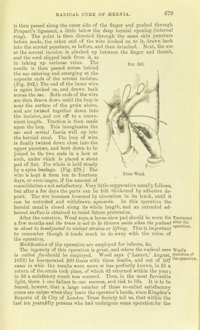 is then passed along tbe outer side of the finger and pushed through Poupart’s ligament, a little helow the deep hernial opening (internal ring). The point is then directed through the same skin puncture before made, the other end of the wire hooked on to it, drawn back into the scrotal puncture, as before, and then detached. Next, the sac at tbe scrotal incision is pinched up between the finger and thumb, and the cord slipped back from it, as in taking up varicose veins. The needle is then passed across behind the sac entering and emerging at the opposite ends of the scrotal incision. (Pig. 282.) The end of the inner wire is again hocked on, and drawn back across the sac. Both ends of the wire are then drawn down until the loop is near the surface of the groin above, and are twisted together down into the incision, and cut off to a conve- nient length. Traction is then made upon the loop. This invaginates the sac and scrotal fascia well up into the hernial cvnul. The loop of wire is finally twiited down close into the upper puncture, and bent down to be joined to tht two ends in a bow or arch, under vhich is placed a stout pad of Hut. The whole is held steady by a spica baidage. (Fig. 278.) The wire is kept h from ten to fourteen days, or even longer, if the amount of consolidation s not satisfactory. Very little suppuration usually follows, but after a fev days the parts can be felt thickened by adhesive de- posit. The w.re becomes loosened bj' ulceration in its track, until it can be untwsted and withdrawn upwards. In this operation the hernial canal is closed along its whole length, and an extended ad- herent surfaci is obtained to resist future protrusion. After the meration. Wood says, a horse-shoe pad should be worn for Treatment a few months and the truss is not to he throton aside when the patient is about to besubjected to violent strains or lifting. This is important to remember though it tends much to do away with the value of the operation. Modificatiois of the operation are employed for infants, &c. The ingenuty of this operation is great, and where the radical cure Wood’s is called for should be employed. Wood says (‘ Lancet,’ August, statistics of 1873) he has operated 200 times with three deaths, and out of 197 me operation, cases in wide, the results were more or less perfectly known, in 51 a return of the leruia took place, of which 42 returned within the year; in 56 a satisfetory result was secured. Thus, in the most favorable light, there ii one failure to one success, and risk to life. It is to be feared, howevr, that a large number of these so-called satisfactory cures are onlyso when they leave the operator’s hands, since Kingdon’s Reports of tb City of London Truss Society tell us, that within the last ten years^ifty persons who had undergone some operation for the Fig. 282. [ From Wood.