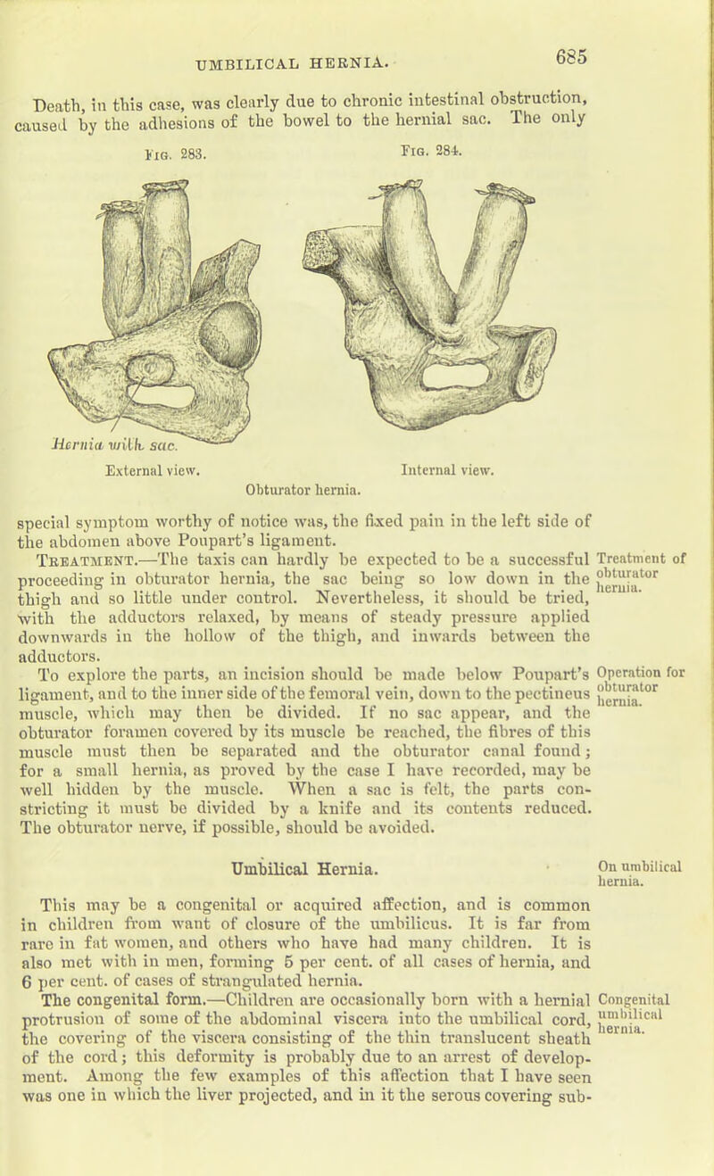 Death, in this case, was clearly due to chronic intestinal obstruction, caused by the adhesions of the bowel to the hernial sac. The only Fig. 283. I'm. 284. Hernia, with, sac. E.xternal view. Internal view. Obturator hernia. special symptom worthy of notice xvas, the fixed pain in the left side of the abdomen above Poupart’s ligament. Treatment.—The taxis can hardly be expected to be a successful Treatment of proceeding in obturator hernia, the sac being so low down in the thigh and so little under control. Nevertheless, it should be tried, with the adductors relaxed, by means of steady pressure applied downwards in the hollow of the thigh, and inwards between the adductors. To explore the parts, an incision should be made below Poupart’s Operation for ligament, and to the inner side of the femoral vein, down to the pectineus muscle, which may then be divided. If no sac appear, and the obturator foramen covered by its muscle be reached, the fibres of this muscle must then be separated and the obturator canal found; for a small hernia, as proved by the case I have recorded, may be well hidden by the muscle. When a sac is felt, the parts con- stricting it must be divided by a knife and its contents reduced. The obturator nerve, if possible, should bo avoided. This may be a congenital or acquired affection, and is common in children from want of closure of the umbilicus. It is far from rare in fat women, and others who have had many children. It is also met with in men, forming 5 per cent, of all cases of hernia, and 6 i>er cent, of cases of strangulated hernia. The congenital form.—Children are occasionally born with a hernial Congenital protrusion of some of the abdominal viscera into the umbilical cord, ^ernia*^”^ the covering of the viscera consisting of the thin translucent sheath of the cord; this deformity is probably due to an arrest of develop- ment. Among the few examples of this affection that I have seen was one in which the liver projected, and in it the serous covering sub- UmbUical Hernia. On umbilical hernia.