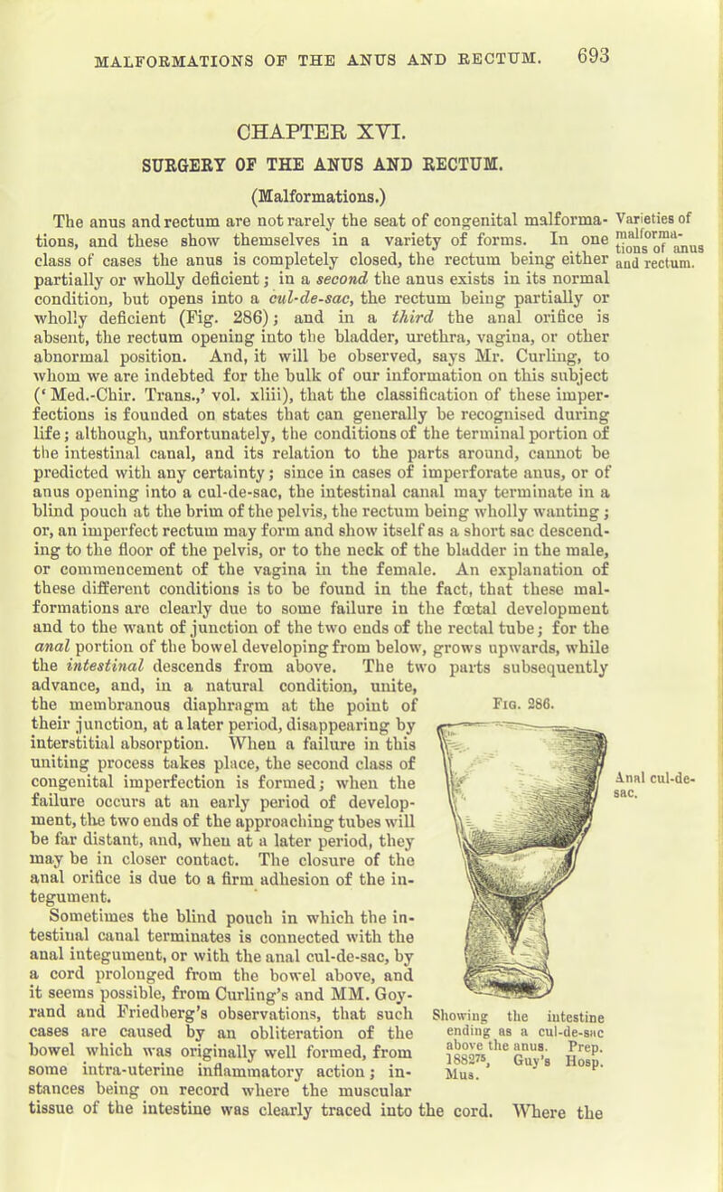 CHAPTER XVI. SURGERY OF THE ANUS AND RECTUM. (Malformations.) The anus and rectum are not rarely the seat of congenital malforma- Varieties of tions, and these show themselves in a variety of forms. In one class of cases the anus is completely closed, tlie rectum being either rectum, partially or wholly deficient; in a second the anus exists in its normal condition, but opens into a cul-de-sac, the rectum being partially or wholly deficient (Fig. 286); and in a third the anal orifice is absent, the rectum opening into the bladder, urethra, vagina, or other abnormal position. And, it will be observed, says Mr. Curling, to whom we are indebted for the hulk of our information on this subject (‘ Med.-Chir. Trans.,’ vol. xliii), that the classification of these imper- fections is founded on states that can generally be recognised during life; although, unfortunately, the conditions of the terminal portion of the intestinal canal, and its relation to the parts around, cannot be predicted with any certainty; since in cases of imperforate anus, or of anus opening into a cul-de-sac, the intestinal canal may terminate in a blind pouch at the brim of the pelvis, the rectum being wholly wanting j or, an imperfect rectum may form and show itself as a short sac descend- ing to the fioor of the pelvis, or to the neck of the bladder in the male, or commencement of the vagina in the female. An explanation of these different conditions is to be found in the fact, that these mal- formations are clearly due to some failure in the foetal development and to the want of junction of the two ends of the rectal tube; for the anal portion of the bowel developing from below, grows upwards, while the intestinal descends from above. The two parts subsequently advance, and, in a natural condition, unite, the membranous diaphragm at the point of Fm. 286. their junction, at a later period, disappearing by interstitial absorption. When a failure in this uniting process takes place, the second class of congenital imperfection is formed; when the failure occurs at an early period of develop- ment, tlie two ends of the approaching tubes will be far distant, and, when at a later period, they may be in closer contact. The closure of the anal orifice is due to a firm adhesion of the in- tegument. Sometimes the blind pouch in which the in- testinal canal terminates is connected with the anal integument, or with the anal cul-de-sac, by a cord prolonged from the bowel above, and it seems possible, from Curling’s and MM. Goy- rand and Friedberg’s observations, that such cases are caused by an obliteration of the bowel which was originally well formed, from some intra-uterine infiammatory action; in- stances being on record where the muscular tissue of the intestine was clearly traced into the cord. Where the Lnal cul-de- sac. Showing the iutestine ending as a cul-de-sac above the anus. Prep. 188275, Guy’s Hosp. Mus.