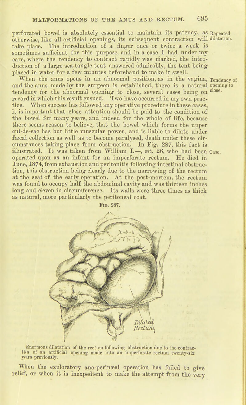 perforated bowel is absolutely essential to maintain its patency, as Repeated otlierwise, like all artificial openings, its subsequent contraction will dilatation, take place. Tbe introduction of a finger once or twice a week is sometimes sufficient for this purpose, and in a case I had under my care, where the tendency to contract rapidly was marked, the intro- duction of a large sea-tangle tent answered admirably, the tent being placed in water for a few minutes beforehand to make it swell. When the anus opens in an abnormal position, as in the vagina. Tendency of and the anus made by the surgeon is established, there is a natural opening to tendency for the abnormal opening to close, several cases being on record in which this result ensued. Two have occurred in my own prac- tice. When success has followed any operative procedure in these cases, it is important that close attention should be paid to the condition of the bowel for many years, and indeed for the whole of life, because there seems reason to believe, that the bowel which fonns the upper cul-de-sac lias but little muscular power, and is liable to dilate under faecal collection as well as to become paralysed, death under these cir- cumstances taking place from obstruction. In Fig. 287, this fact is illustrated. It was taken from William L—, aet. 26, who had been Case, operated upon as an infant for an imperforate rectum. He died in June, 1874, from exhaustion and peritonitis following intestinal obstruc- tion, this obstruction being clearly due to the narrowing of the rectum at the seat of the early operation. At the post-mortem, the rectum was found to occupy half the abdominal cavity and was thirteen inches long and eleven in circumference. Its walls were three times as thick as natural, more particularly the peritoneal coat. Enormous dilatation of the rectum following obstruction due to the contrac- tim of an artificial opening made into an imperforate rectum twenty-six years previously. llhen the exploratory ano-perinseal operation has failed to give relitf, or when it is inexpedient to make the attempt from the very Fig. 287.
