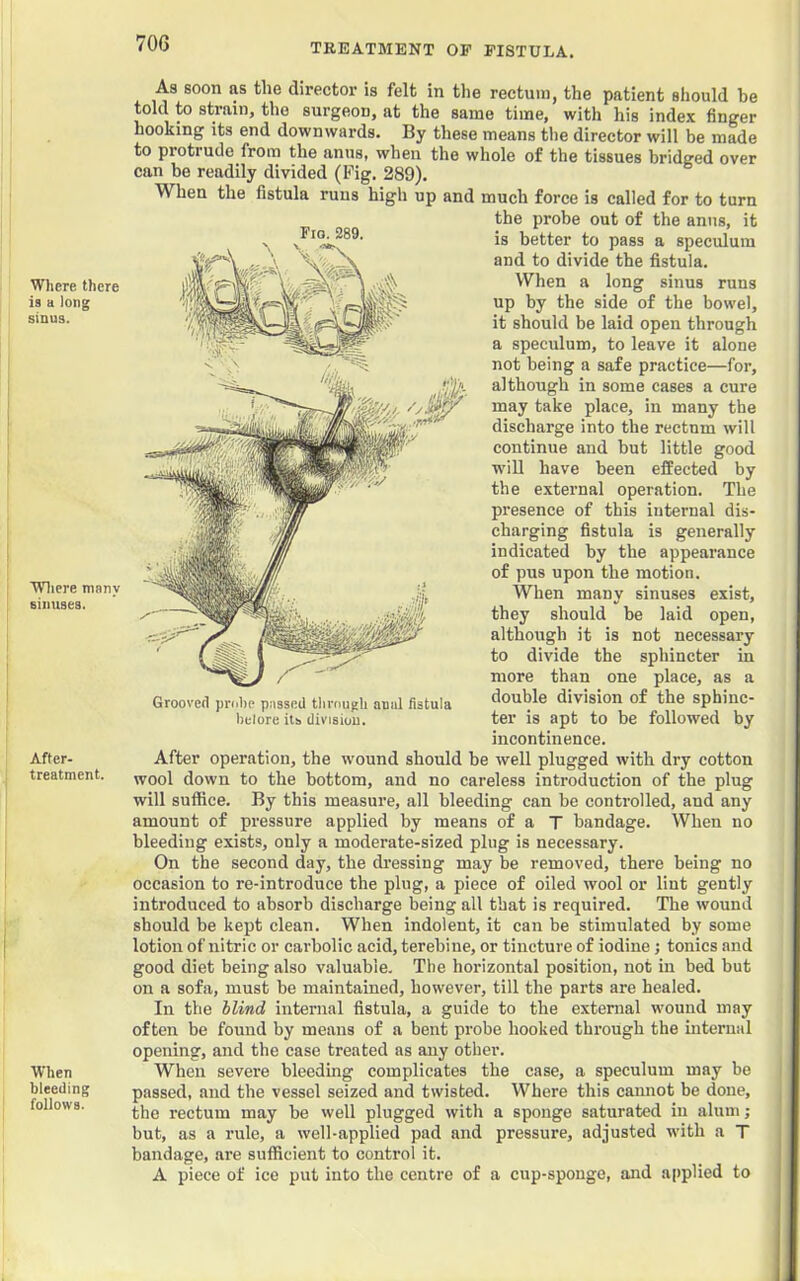 TREATMENT OF FISTULA. Where there ia a long sinus. Wliere many sinuses. After- treatment. When bleeding follows. As soon as the director is felt in the rectum, the patient should he told to strain, the surgeon, at the same time, with his index finger hooking its end downwards. By these means the director will be made to protrude^from the anus, when the whole of the tissues bridged over can be readily divided (Fig. 289). When the fistula runs high up and much force is called for to turn the probe out of the anus, it is better to pass a speculum and to divide the fistula. When a long sinus runs up by the side of the bowel, it should be laid open through a speculum, to leave it alone not being a safe practice—for, although in some cases a cure may take place, in many the discharge into the rectum will continue and but little good will have been effected by the external operation. The presence of this internal dis- charging fistula is generally indicated by the appearance of pus upon the motion. When many sinuses exist, they should be laid open, although it is not necessary to divide the sphincter in more than one place, as a double division of the sphinc- ter is apt to be followed by incontinence. After operation, the wound should be well plugged with dry cotton wool down to the bottom, and no careless introduction of the plug will suffice. By this measure, all bleeding can be controlled, and any amount of pressure applied by means of a T bandage. When no bleeding exists, only a moderate-sized plug is necessary. On the second day, the dressing may be removed, there being no occasion to re-introduce the plug, a piece of oiled wool or lint gently introduced to absorb discharge being all that is required. The wound should be kept clean. When indolent, it can be stimulated by some lotion of nitric or carbolic acid, terebine, or tincture of iodine; tonics and good diet being also valuable. The horizontiil position, not in bed but on a sofa, must be maintained, however, till the parts are healed. In the blind internal fistula, a guide to the external wound may often be found by means of a bent probe hooked through the internal opening, and the case treated as any other. When severe bleeding complicates the case, a speculum may be passed, and the vessel seized and twisted. Where this cannot be done, the rectum may be well plugged with a sponge saturated in alum; but, as a rule, a well-applied pad and pressure, adjusted with a T bandage, are sufficient to control it. A piece of ice put into the centre of a cup-sponge, and applied to Fio. 289. Grooved probe passed tlirougli anal fistula belore its division.