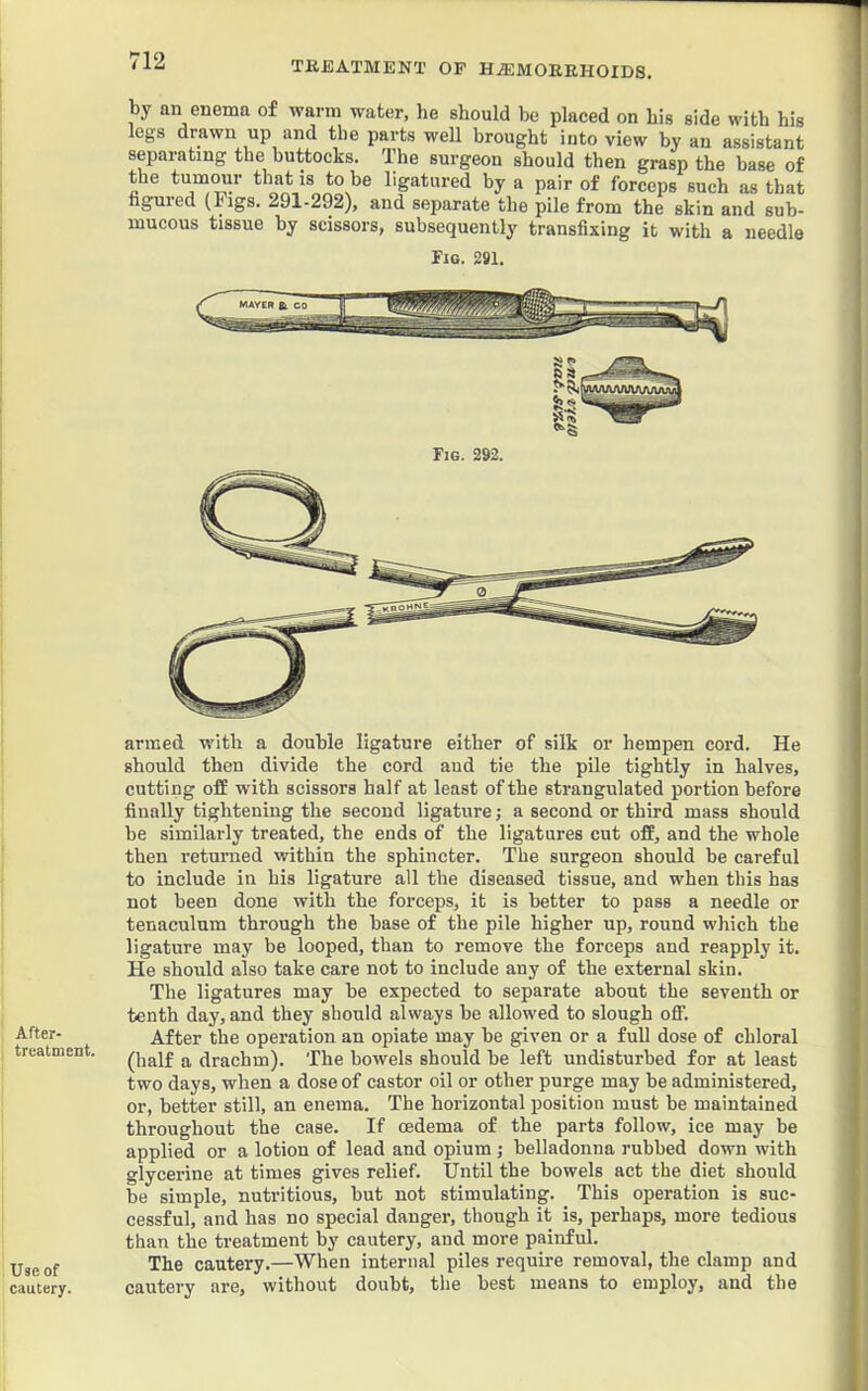 After- treatment. Use of cautery. TREATMENT OP H.®MOERHOIDS. by an enema of warm water, he should he placed on his side with his legs drawn up and the parts weU brought into view by an assistant separating the buttocks. The surgeon should then grasp the base of the turner that is to be ligatured by a pair of forceps such as that nguied (Figs. 291-292), and separate the pile from the skin and sub- mucous tissue by scissors, subsequently transfixing it with a needle Fig. 291. armed with a double ligature either of silk or hempen cord. He should then divide the cord aud tie the pile tightly in halves, cutting off with scissors half at least of the strangulated portion before finally tightening the second ligature; a second or third mass should be similarly treated, the ends of the ligatures cut off, and the whole then returned within the sphincter. The surgeon should be careful to include in his ligature all the diseased tissue, and when this has not been done with the forceps, it is better to pass a needle or tenaculum through the base of the pile higher up, round which the ligature may be looped, than to remove the forceps and reapply it. He should also take care not to include any of the external skin. The ligatures may be expected to separate about the seventh or tenth day, and they should always be allowed to slough off. After the operation an opiate may be given or a full dose of chloral (half a drachm). The bowels should be left undisturbed for at least two days, when a dose of castor oil or other purge may be administered, or, better still, an enema. The horizontal position must be maintained throughout the case. If oedema of the parts follow, ice may be applied or a lotion of lead and opium; belladonna rubbed down with glycerine at times gives relief. Until the bowels act the diet should be simple, nutritious, but not stimulating. This operation is suc- cessful, and has no special danger, though it is, perhaps, more tedious than the treatment by cautery, and more painful. The cautery.—When internal piles require removal, the clamp and cautery are, without doubt, the best means to employ, and the