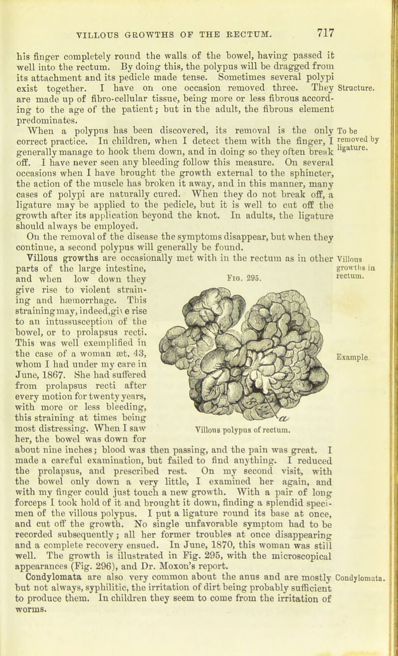 ! 5 i '1 his finger completely round the walls of the howel, having passed it well into tlie rectum. By doing this, the polypus will be di-agged from its attachment and its pedicle made tense. Sometimes several polypi exist together. I have on one occasion removed three. They Structure, are made up of fibro-cellular tissue, being more or less fibrous accord- ing to the age of the patient; hut in the adult, the fibrous element predominates. When a polypus has been discovered, its removal is the only To be correct practice. In children, when I detect them with the finger, I removed by generally manage to hook them down, and in doing so they often break off. I have never seen any bleeding follow this measure. On several occasions when I have brought tbe growth external to the sphincter, the action of the muscle has broken it away, and in this manner, many cases of polypi are naturally cured. When they do not break off, a ligature may be applied to the pedicle, but it is well to cut off tbe growth after its application beyond the knot. In adults, the ligature should always be employed. On the removal of the disease the symptoms disappear, but when they continue, a second polypus will generally be found. Villous growths are occasionally met with in the rectum as in other Villons parts of the large intestine, and when low down they give rise to violent strain- ing and hajmorrhage. This strainingmay, indeed,gi\ e rise to an intussusception of the bowel, or to prolapsus recti. This was well exemplified in the case of a woman set. 43, whom I had under my care in June, 1867. She had suflered from prolapsus recti after every motion for twenty years, with more or less bleeding, this straining at times being most distressing. When I saw her, the bowel was down for about nine inches; blood was then passing, and the pain was great. I made a careful examination, but failed to find anything. I reduced the prolapsus, and prescribed rest. On my second visit, with the bowel only down a very little, I examined her again, and with my finger could just touch a new growth. With a pair of long forceps I took hold of it and brought it down, finding a splendid speci- men of the villous polypus. I put a ligature round its base at once, and cut off the growth. No single unfavorable symptom had to be recorded subsequently; all her former troubles at once disappearing and a complete recovery ensued. In June, 1870, this woman was still well. The growth is illustrated in Fig. 295, with the microscopical appearances (Fig. 296), and Dr. Moxon’s report. Condylomata are also very common about the anus and are mostly Condylomata. hut not always, syphilitic, the irritation of dirt being probably sufficient to produce them. In children they seem to come from the irritation of worms. growths in Fig. 295. rectum. Villotis polypus of rectum. 1