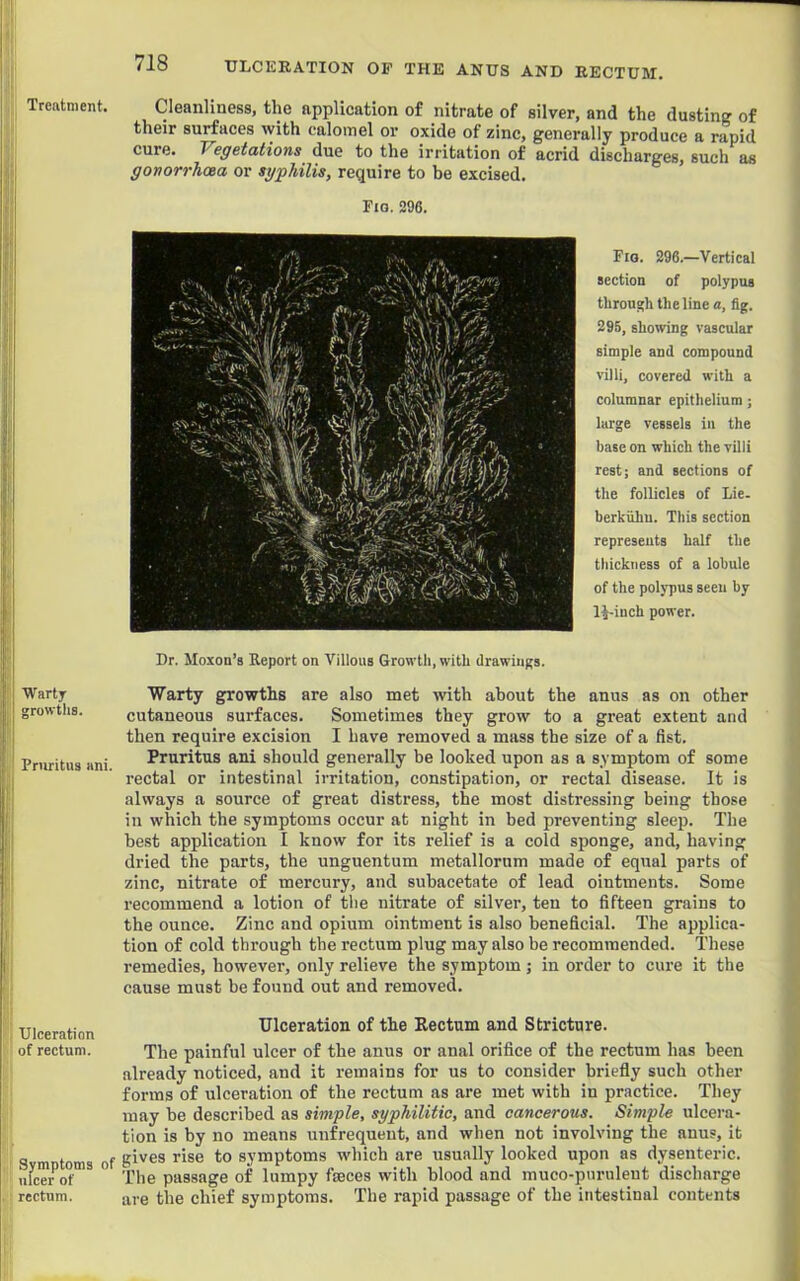 Treatment. Cleanliness, the application of nitrate of silver, and the dusting of their surfaces with calomel or oxide of zinc, generally produce a rapid cure. Vegetations due to the irritation of acrid discharges, such as gonorrhoea or sgphilis, require to be excised. Fio. 296. Fro. 296.—Vertical section of polypus through the line a, fig. 295, showing vascular simple and compound villi, covered with a columnar epithelium ; large vessels in the base on which the villi rest; and sections of the follicles of Lie. berkiihu. This section represents half the thickness of a lobule of the polypus seen by IJ-inch power. Dr. Moxon’s Keport on Villous Growth, with drawings. Warty growths. Pnu-itus ani. Warty gptowths are also met with about the anus as on other cutaneous surfaces. Sometimes they grow to a great extent and then require excision I have removed a mass the size of a fist. Pruritus ani should generally be looked upon as a symptom of some rectal or intestinal irritation, constipation, or rectal disease. It is always a source of great distress, the most distressing being those in which the symptoms occur at night in bed preventing sleep. The best application I know for its relief is a cold sponge, and, having dried the parts, the unguentum metallorum made of equal parts of zinc, nitrate of mercury, and subacetate of lead ointments. Some recommend a lotion of the nitrate of silver, ten to fifteen grains to the ounce. Zinc and opium ointment is also beneficial. The applica- tion of cold through the rectum plug may also be recommended. These remedies, however, only relieve the symptom j in order to cure it the cause must be found out and removed. Ulceration of rectum. Symptoms of ulcer of rectum. Ulceration of the Eectum and Stricture. The painful ulcer of the anus or anal orifice of the rectum has been already noticed, and it remains for us to consider briefly such other forms of ulceration of the rectum as are met with in practice. They may be described as simple, syphilitic, and cancerous. Simple ulcera- tion is by no means unfrequent, and when not involving the anus, it gives rise to symptoms which are usually looked upon as dysenteric. The passage of lumpy fseces with blood and muco-pnruleut discharge are the chief symptoms. The rapid passage of the intestinal contents