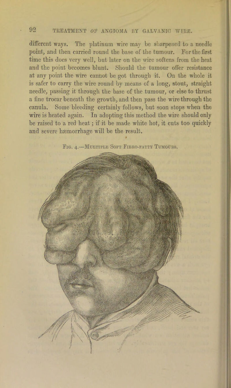 different ways. The platinum wire may be sharpened to a needle point, and then carried round the base of the tumour. Tor the first time this does very well, but later on the wire softens from the heat and the point becomes blunt. Should the tumour offer resistance at any point the wire cannot be got through it. On the whole it is safer to carry the wire round by means of a long, stout, straight needle, passing it through the base of the tumour, or else to thrust a fine trocar beneath the growth, and then pass the wire through the canula. Some bleeding certainly follows, but soon stops when the wire is heated again. In adopting this method the wire should only be raised to a red heat; if it be made white hot, it cuts too quickly and severe haemorrhage will be the result. Fio. 4.—Multiple Soft Fibro-fatty Tumours.