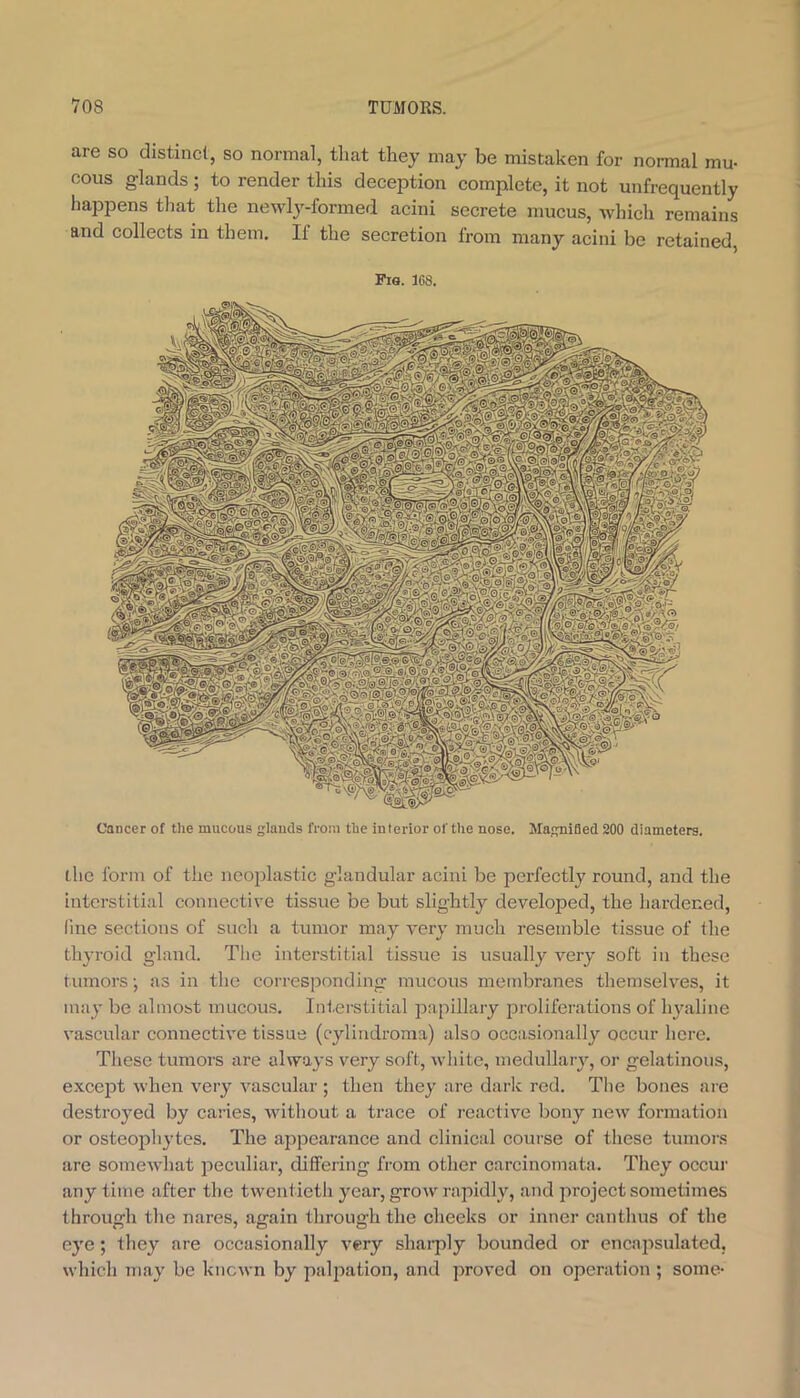 Cancer of the mucous glands from the interior of the nose. Magnified 200 diameters. flic form of the neoplastic glandular acini be perfectly round, and the interstitial connective tissue be but slightly developed, the hardened, fine sections of such a tumor may very much resemble tissue of the thyroid gland. The interstitial tissue is usually v^ery soft in these tumors; as in the corresponding mucous membranes themselves, it may be almost mucous. Intei'stitial ijapillary proliferations of hyaline vascular connective tissue (cylindroma) also occasionally occur here. These tumors are always very soft, white, medullary, or gelatinous, except when very vascular ; then they are darlc red. The bones are destroyed by caries, without a trace of reactive bony new formation or osteoj^hytes. The appearance and clinical course of these tumors are somewdiat peculiar, differing from other carcinomata. They occui’ any time after the twentieth year, grow rapidly, and project sometimes through the nares, again through the cheeks or inner canthus of the eye; they are occasionally very sharply bounded or encapsulated, which may be known by palpation, and proved on operation ; some- are so distinct, so normal, that they may be mistaken for normal mu- cous glands; to render this deception complete, it not unfrequently happens that the newly-formed acini secrete mucus, Avhich remains and collects in them. If the secretion from many acini be retained, Fig. 168.