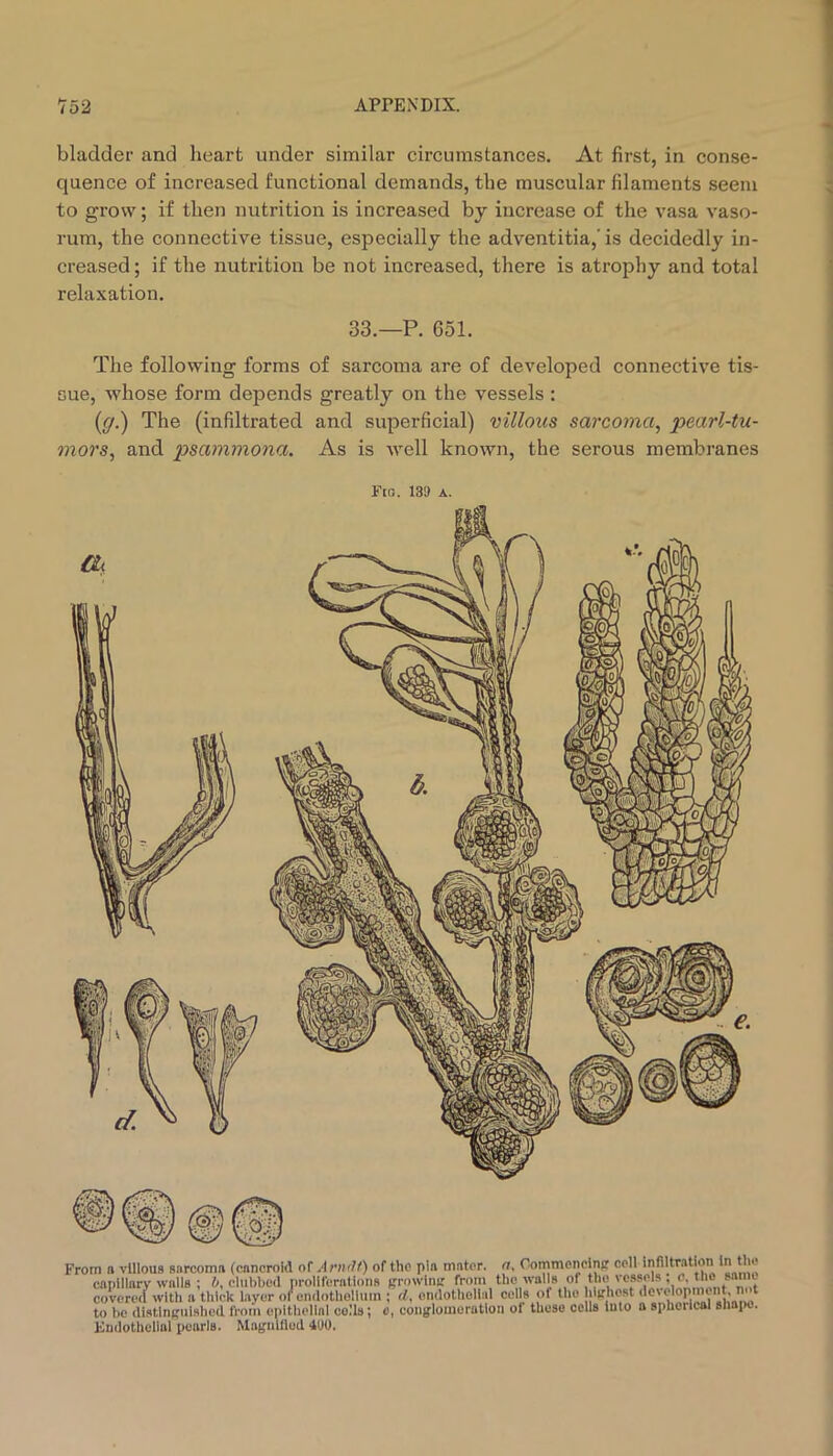 bladder and heart under similar circumstances. At first, in conse- quence of increased functional demands, the muscular filaments seem to grow; if then nutrition is increased by increase of the vasa vaso- rum, the connective tissue, especially the adventitia,'is decidedly in- creased ; if the nutrition be not increased, there is atrophy and total relaxation. 33.—P. 651. The following forms of sarcoma are of developed connective tis- sue, whose form depends greatly on the vessels : {g.) The (infiltrated and superficial) villous sarcoma, pearl-tu- mors, and psammona. As is well known, the serous membranes Fia. 139 A. From n vlllouB sarcoma (cancroid of A nirlt) of the pin mater, ft, Oommonclnp coll infiltration in tlu. capillary walls ; &, clubbed proliferations (-rowini: covered with n thick layer of cmlothollum ; d, endothelial cells of the ‘ to be distlnRulshed from epithelial colls; o, conglomeration of these cells into n spherical 8hai>o. Endothelial pearls. Magnified 490.