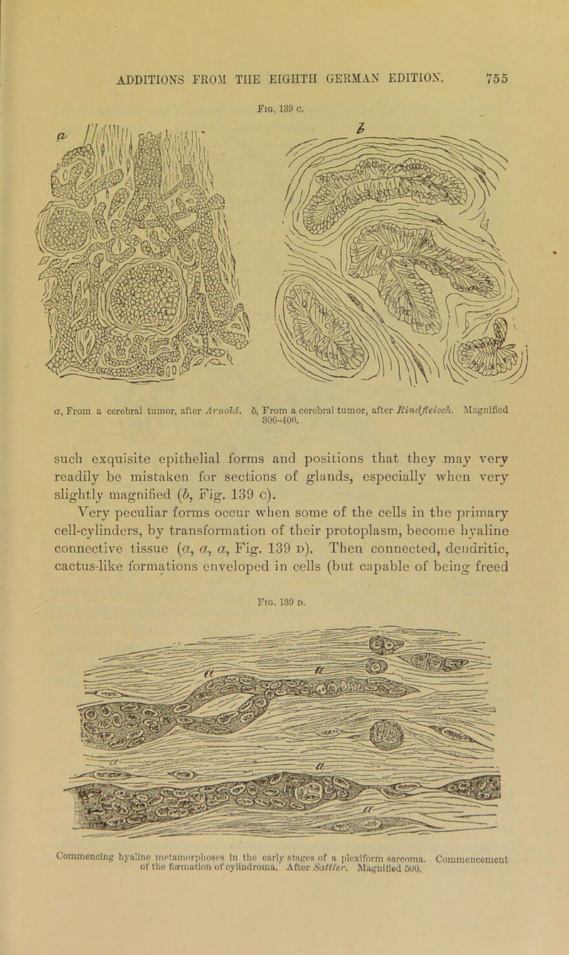 Fig. 189 o. a, From a cerebral tumor, alter JriioM, b, From a cerebral tumor, after RindfleiBch. Magnified 300-100. such exquisite epithelial forms and positions that they may very readily be mistaken for sections of glands, especially when very slightly magnified {b. Fig. 139 c). Very peculiar forms occur when some of the cells in the primary cell-cylinders, by transformation of their protoplasm, become hyaline connective tissue (a, a, «, Fig. 139 d). Then connected, dendritic, cactus-like formations enveloped in cells (but capable of being freed Fro. 139 D. Commencing hyaline metamoriilioHcs In the early stages of a jilcxiform sarcoma. Commencement of the formation of cylindroma. After Hattler. Mugnillcd 000.