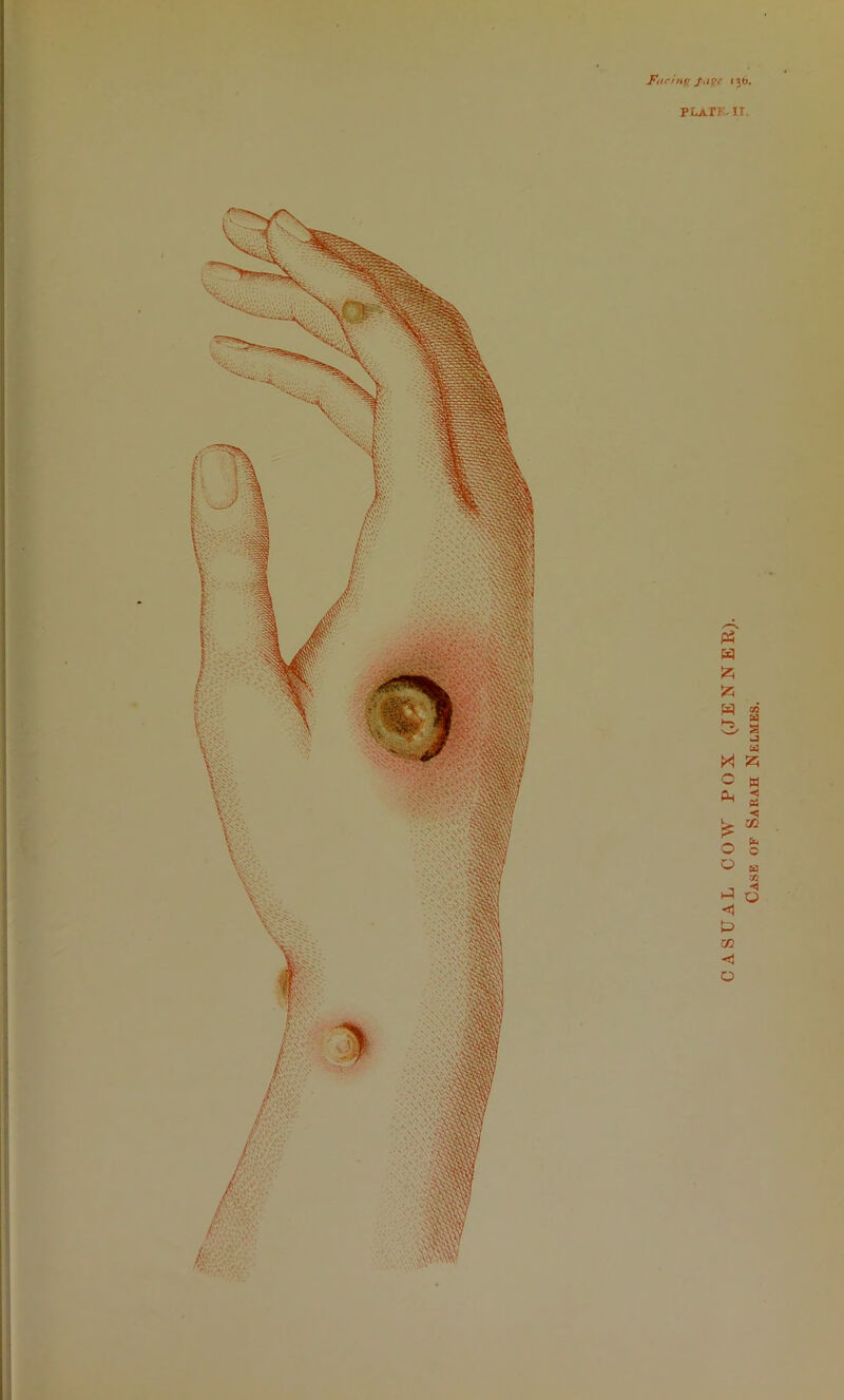 13b. PLArF..II. CASUAL COW POX (JENNER). Case of Sarah Xelmes.