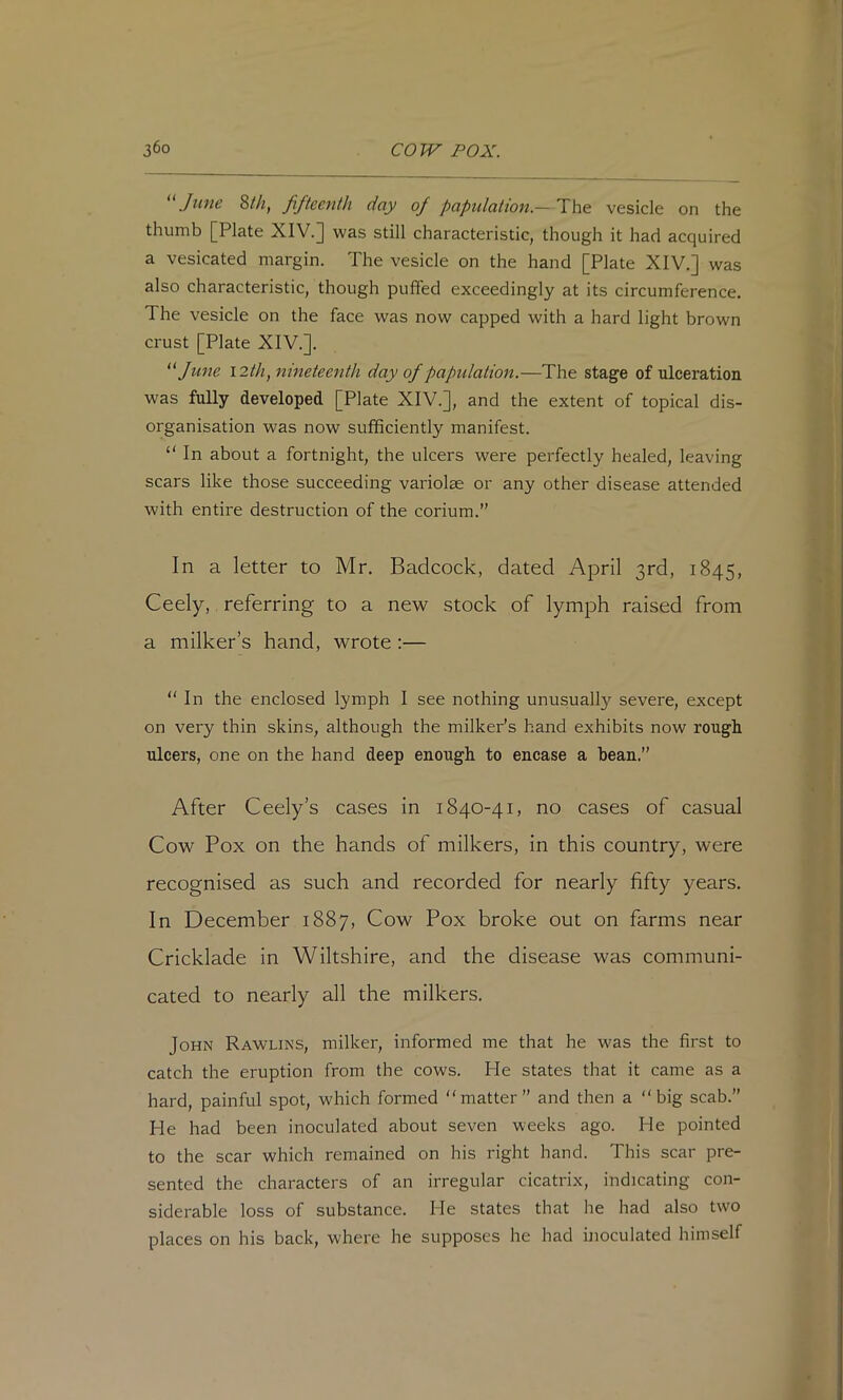 '‘June 8//i, fifteenth day of papulation.—The vesicle on the thumb [Plate XIV.] was still characteristic, though it had acquired a vesicated margin. The vesicle on the hand [Plate XIV.] was also characteristic, though puffed exceedingly at its circumference. The vesicle on the face was now capped with a hard light brown crust [Plate XIV.]. ^‘June I2th, nineteenth day of papulation.—The stage of ulceration was fully developed [Plate XIV.], and the extent of topical dis- organisation was now sufficiently manifest. “ In about a fortnight, the ulcers were perfectly healed, leaving scars like those succeeding variolae or any other disease attended with entire destruction of the corium.” In a letter to Mr. Badcock, dated April 3rd, 1845, Ceely, referring to a ne^v stock of lymph raised from a milker’s hand, wrote :—  In the enclosed lymph I see nothing unusually severe, except on very thin skins, although the milker’s hand exhibits now rough ulcers, one on the hand deep enough to encase a bean.” After Ceely’s cases in 1840-41, no cases of casual Cow Pox on the hands of milkers, in this country, were recognised as such and recorded for nearly fifty years. In December 1887, Cow Pox broke out on farms near Cricklade in Wiltshire, and the disease was communi- cated to nearly all the milkers. John Rawlins, milker, informed me that he was the first to catch the eruption from the cows. He states that it came as a hard, painful spot, which formed ‘‘matter” and then a “big scab.” He had been inoculated about seven weeks ago. He pointed to the scar which remained on his right hand. This scar pre- sented the characters of an irregular cicatrix, indicating con- siderable loss of substance. He states that he had also two places on his back, where he supposes he had inoculated himself