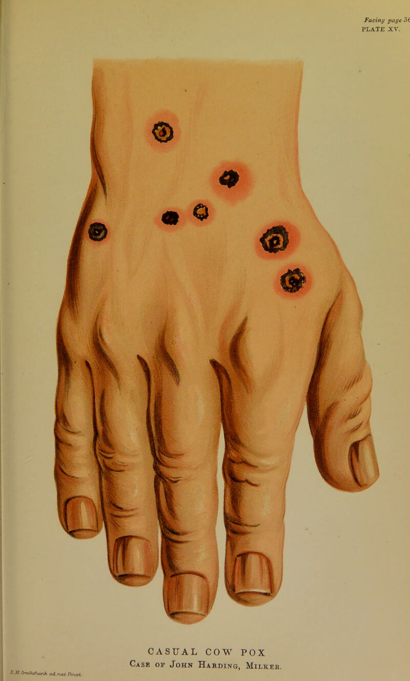 Facing j>age 3i PLATE JCV. EM. (rfiok^iarik. odL. nnl Amc4. CASUAL COW POX Case of John Hahding, Milkek.