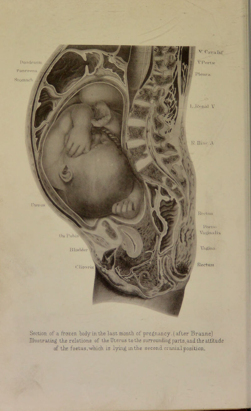 mn.I.lHi- . i' lltoriss Rect-iim us Os 1 ’iilii: Section of a frozen body in the last montli of pregnancy. {after Bratme) niiistrating the relations of the Uterus to tlie surrounding parts, and the attitade of the foetus,Which is lying in the second cranialposition.