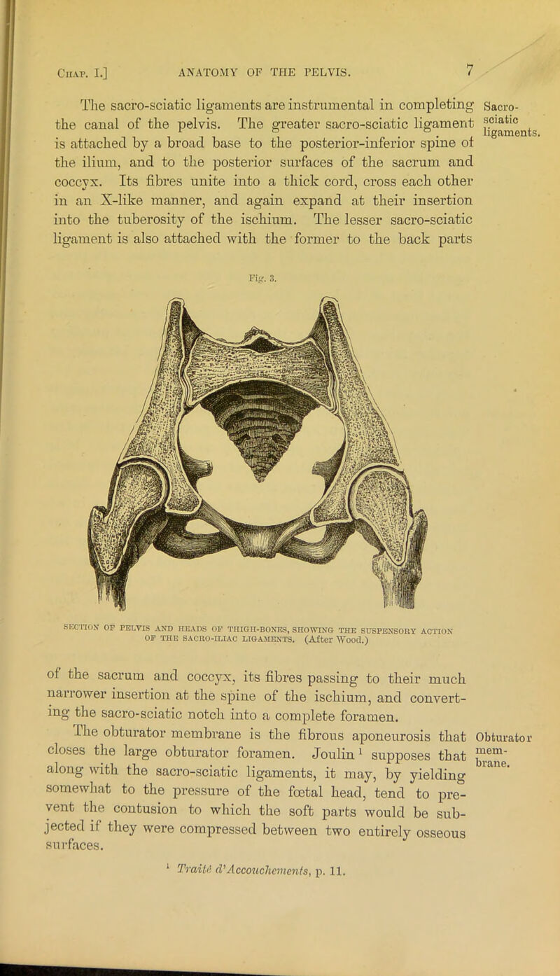 The sacro-sciatic ligaments are instrumental in completing Sacro- the canal of the pelvis. The greater sacro-sciatic ligament sciatic 111 1 . . „ . . , ligaments, is attached by a broad base to the posterior-inferior spine ot the ilium, and to the posterior surfaces of the sacrum and coccvx. Its fibres unite into a thick cord, cross each other in an X-like manner, and again expand at their insertion into the tuberosity of the ischium. The lesser sacro-sciatic ligament is also attached with the former to the back parts FiK. .s. SKc nox OF pnr.vis axd iieaos of thigh-boxes, showing the suspexsoey action OP the sacro-iliac ligaments. (After Wood.) of the sacrum and coccyx, its fibres passing to their much narrower insertion at the spine of the ischium, and convert- ing the sacro-sciatic notch into a complete foramen. The obturator membrane is the fibrous aponeurosis that Obtm-ator closes the large obturator foramen. Joulin ‘ supposes that along with the sacro-sciatic ligaments, it may, by yielding somewhat to the lu’essure of the foetal head, tend to pre- vent the contusion to which the soft parts would be sub- jected if they were compressed between two entirely osseous surfaces. ‘ Traitil d'Accouchements, p. 11.