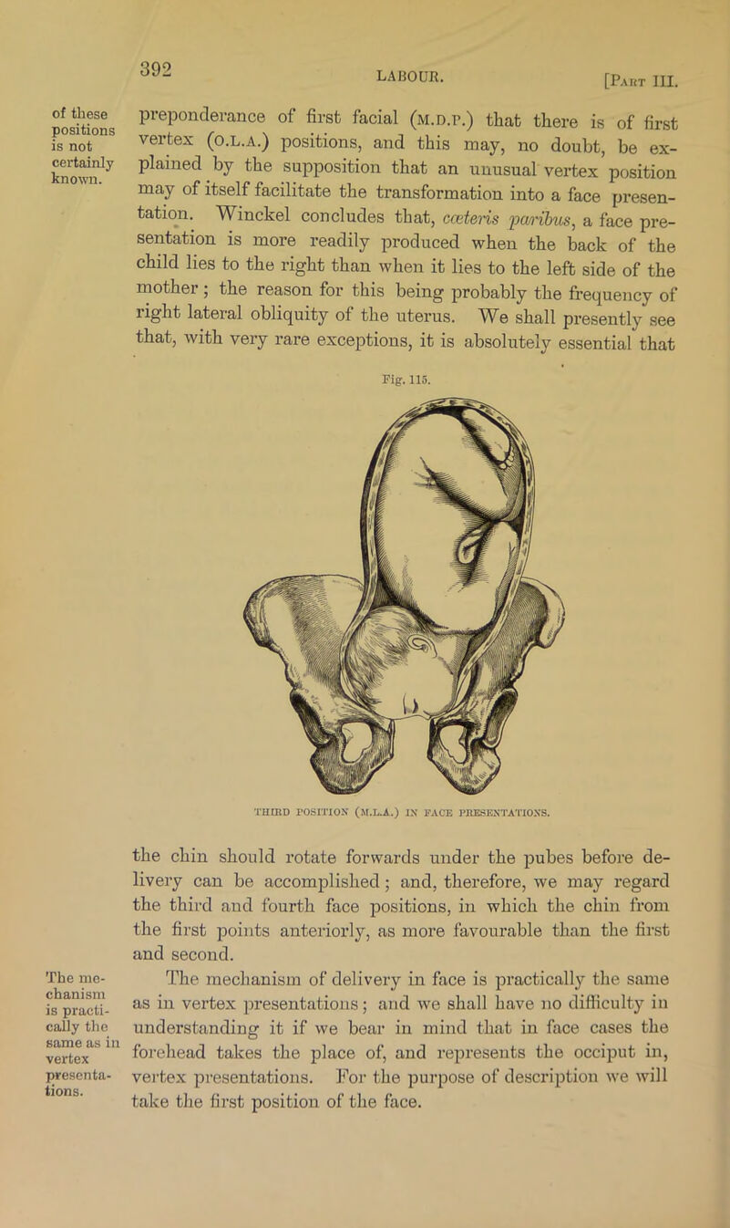 LABOUR. [Pakt III. of these positions is not certainly knoOTi. The me- chanism is practi- cally the same as in vertex presenta- tions. preponderance of first facial (m.d.p.) that there is of first vertex (o.l.a.) positions, and this may, no doubt, be ex- plained by the supposition that an unusual vertex position may of itself facilitate the transformation into a face presen- tation. Winckel concludes that, ccetens paribus^ a face pre- sentation is more readily produced when the back of the child lies to the right than when it lies to the left side of the mother ; the reason for this being probably the frequency of right lateral obliquity of the uterus. We shall presently see that, with very rare exceptions, it is absolutely essential that Fig. 115. THUID POSITION' (M.L.A.) IN' FACE PBESKN'TATION'S. the chin should rotate forwards under the pubes before de- livery can be accomplished; and, therefore, we may regard the third and fourth face positions, in which the chin from the first points anteriorly, as more favourable than the first and second. The mechanism of delivery in face is practically the same as in vertex presentations; and we shall have no difficulty in understanding it if we bear in mind that in face cases the forehead takes the place of, and represents the occiput in, vertex presentations. For the purpose of description we will take the first position of the face.