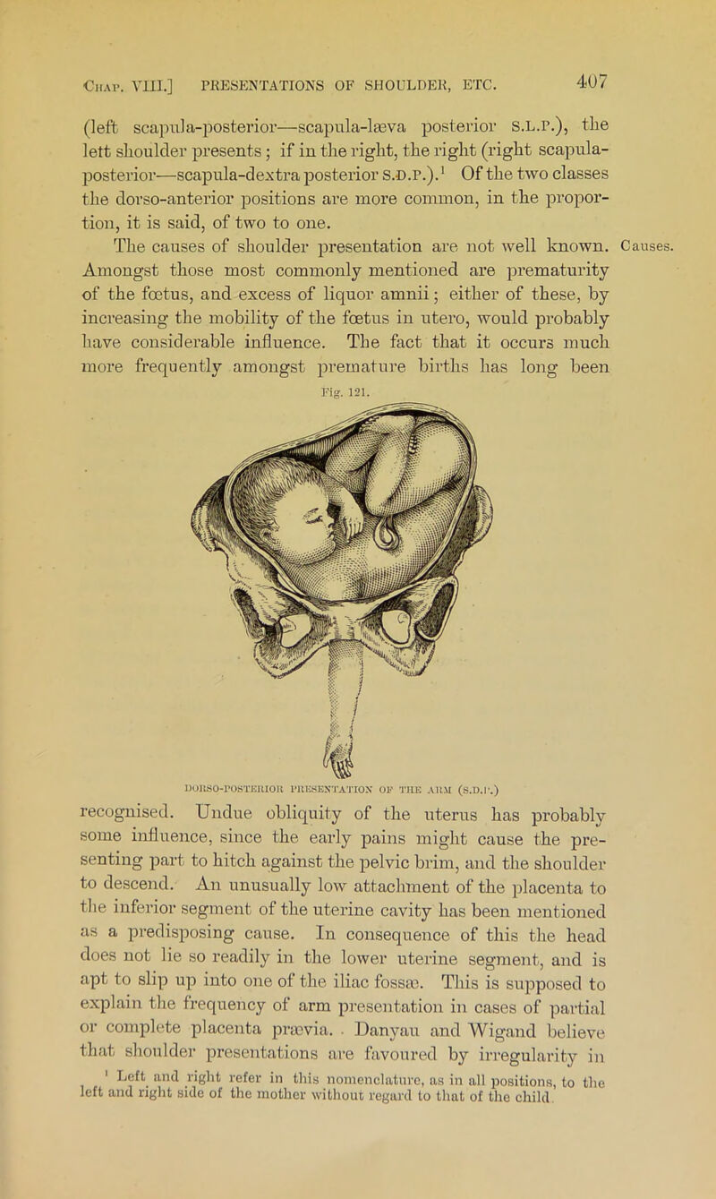 4U7 (left scapula-posterior—scapula-la3va posterior S.L.r.), the lett shoulder presents; if in the right, the right (right scapula- posterior—scapula-dextra posterior S.D.P.). ^ Of the two classes the dorso-anterior positions are more common, in the propor- tion, it is said, of two to one. The causes of shoulder presentation are not well known. Causes. Amongst those most commonly mentioned are prematurity of the foetus, and excess of liquor amnii; either of these, by increasing the mobility of the foetus in utero, would probably have considerable influence. The fact that it occurs much more frequently amongst premature births has long been Fig. 121. DOllSO-rOSTKlUOll I'UISSESTATIOX OF ’I'llE ARM (S.D.I .) recognised. Undue obliquity of the uterus has probably some influence, since the early pains might cause the pre- senting part to hitch against the pelvic brim, and the shoulder to descend. An unusually low attachment of the placenta to the inferior segment of the uterine cavity has been mentioned as a predisposing cause. In consequence of this the head does not lie so readily in the lower uterine segment, and is apt to slip up into one of the iliac fossae. This is supposed to explain the frequency of arm presentation in cases of partial or complete placenta praevia. . Danyau and Wigand believe that shoulder presentations are favoured by irregularity in ' Left and right refer in this nomenclature, as in all positions, to the left and right side of the mother without regard to that of the child.