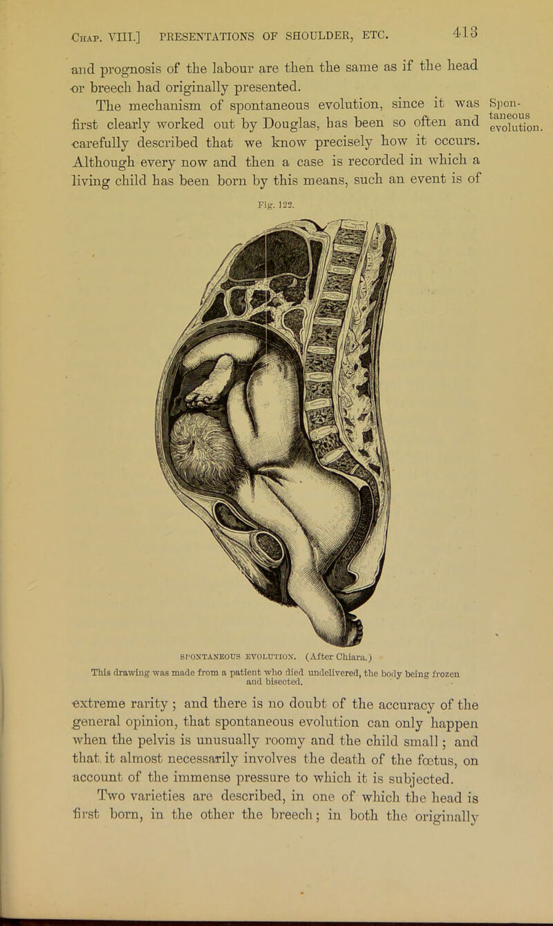 and prognosis of the labour are then the same as if the head or breech had originally presented. The mechanism of spontaneous evolution, since it was first clearly worked out by Douglas, has been so often and ■carefully described that we know precisely how it occurs. Although every now and then a case is recorded in which a living child has been born by this means, such an event is of Fig. 122. SPONTANEOUS EVOLUTION. (After Chiarii.) This drawing was made from a patient wlio died undelivered, the body being frozen and bisected. ■extreme rarity ; and there is no doubt of the accuracy of the general opinion, that spontaneous evolution can only happen when the pelvis is unusually roomy and the child small; and that it almost necessarily involves the death of the foetus, on account of the immense pressure to which it is subjected. Two varieties are described, in one of which the head is first born, in the other the breech; in both the originally Spon- taneous evolution.