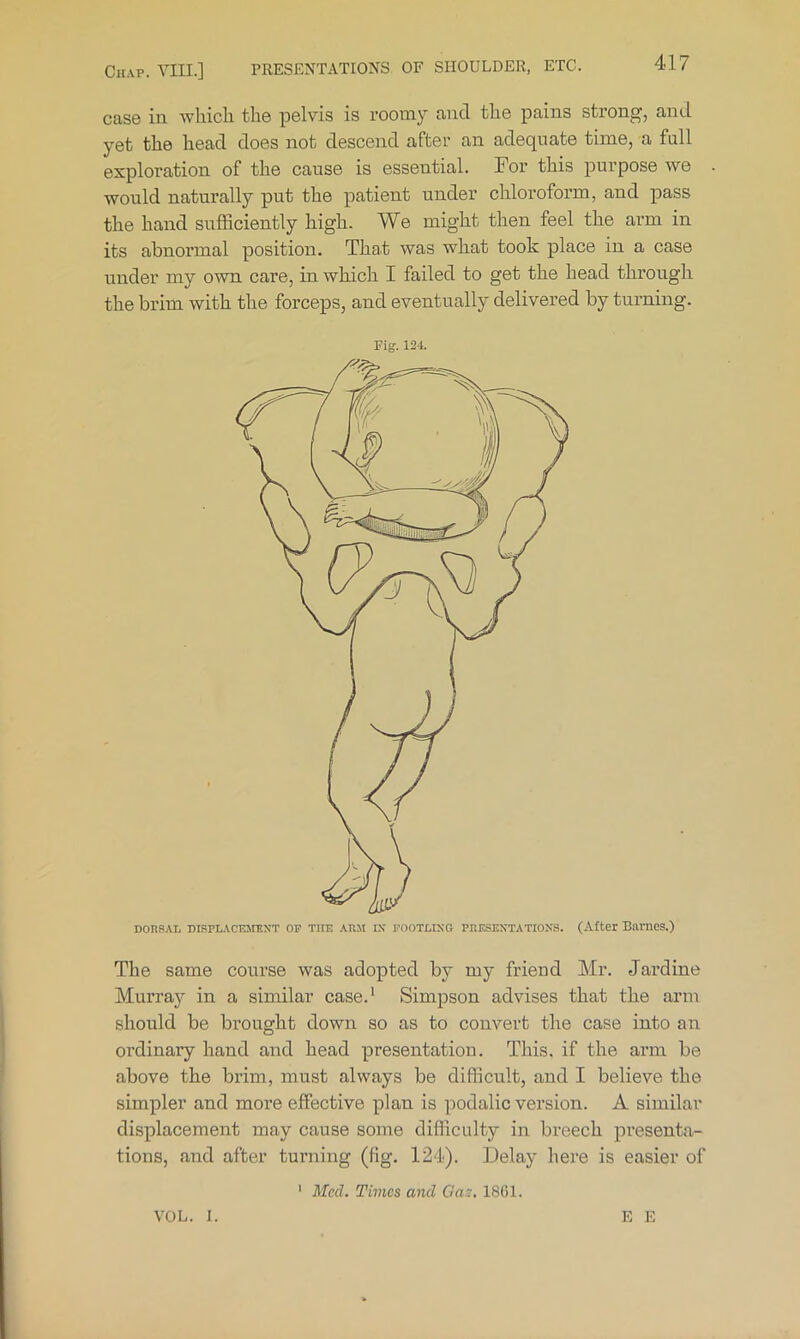 case in which the pelvis is roomy and the pains strong, and yet the head does not descend after an adequate time, a full exploration of the cause is essential. For this purpose we would naturally put the patient under chloroform, and pass the hand sufficiently high. We might then feel the arm in its abnormal position. That was what took place in a case under my own care, in which I failed to get the head through the brim with the forceps, and eventually delivered by turning. Fig. 12-t. DORSAL DI.SPLACroraXT OP THE ARM I\ POOTLIXG PRESENTATIONS. (After BaVRCS.) The same course was adopted by my friend Mr. Jardine Murray in a similar case.’ Simpson advises that the arm should be brought down so as to convert the case into an ordinary hand and head presentation. This, if the arm be above the brim, must always be difficult, and I believe the simpler and more effective plan is podalic version. A similar displacement may cause some difficulty in breech presenta- tions, find after turning (fig. 124). Delay here is easier of ‘ Med. Times and Oaz. 18G1. VOL. I. E E
