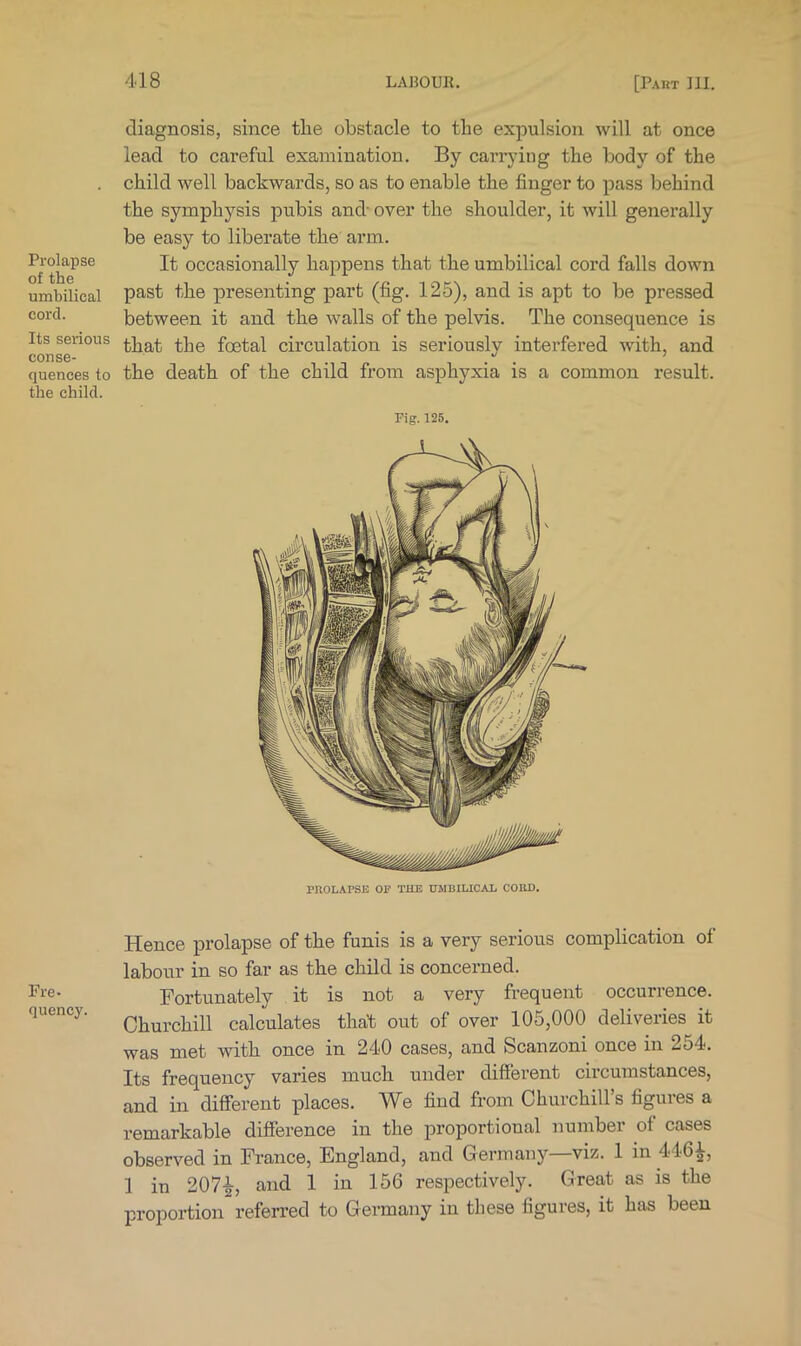 Prolapse of the umbilical cord. Its serious conse- quences to the child. Fre- quency. diagnosis, since tlie obstacle to the expulsion will at once lead to careful examination. By carrying the body of the child well backwards, so as to enable the finger to pass behind the symphysis pubis and'over the shoulder, it will generally be easy to liberate the arm. It occasionally happens that the umbilical cord falls down past the presenting part (fig. 125), and is apt to be pressed between it and the walls of the pelvis. The consequence is that the foetal circulation is seriously interfered with, and the death of the child from asphyxia is a common result. Fig.125. PROLAPSE OP THE UMBILICAL CORD. Hence prolapse of the funis is a very serious complication of labour in so far as the child is concerned. Fortunately it is not a very frequent occurrence. Churchill calculates that out of over 105,000 deliveries it was met with once in 240 cases, and Scanzoni once in 254. Its frequency varies much under different circumstances, and in different places. We find from Churchill’s figures a remarkable difference in the proportional number of cases observed in France, England, and Germany—viz. 1 in 446^, 1 in 207-^, and 1 in 156 respectively. Great as is the proportion referred to Germany in these figures, it has been