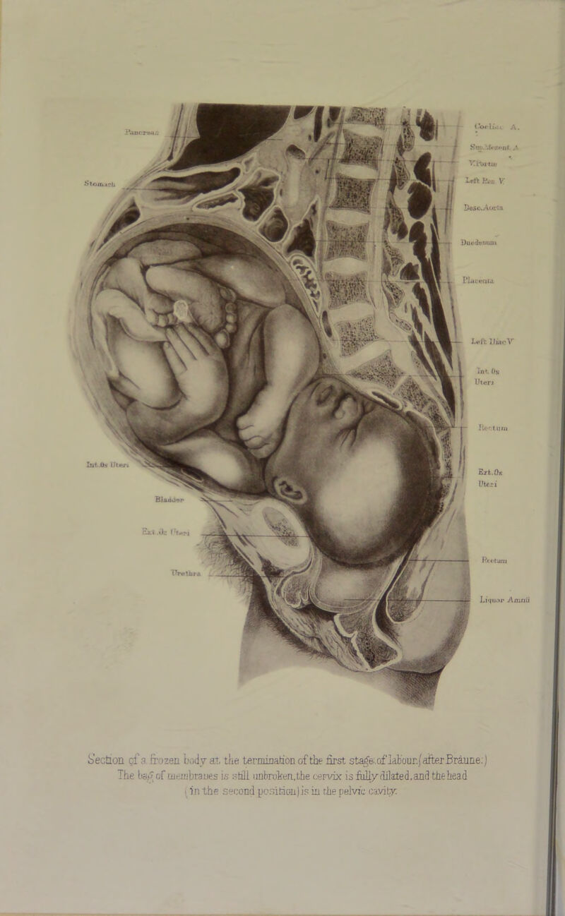 Duodenum Int Os Uteri Her: turn Slonijrh Pl.iieuEa left. IJiaoV Erfc.OK Uteri Rtiihuu Liquor Amnii A. {?«/. Yltntw left Ron V* DeSc.Aor:a Int Os- Uteri Blftiioer Exl.it f'ten Urethra Section of a frozen body at the termination of the first sta^s.of labour./after Braune:) The ta/» of membraues is still unbroken,the cervix is full/ dilated, and the head i in the second position)is in r.he pelvic cavity;
