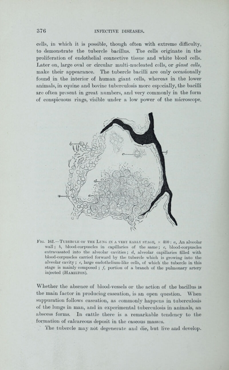 cells, in which it is possible, though often with extreme difficulty, to demonstrate the tubercle bacillus. The cells originate in the proliferation of endothelial connective tissue and white blood cells. Later on, large oval or circular multi-nucleated cells, or giant cells, make their appearance. The tubercle bacilli are only occasionally found in the interior of human giant cells, whereas in the lower animals, in equine and bovine tuberculosis more especially, the bacilli are often present in great numbers, and very commonly in the form of conspicuous rings, visible under a low power of the microscope. Fig. 161.—Tubercle or the Lung in a very early stage, x 400 : a, An alveolar wall; b, blood-corpuscles in capillaries of the same; c, blood-corpuscles extravasated into the alveolar cavities; d, alveolar capillaries filled with blood-corpuscles carried forward by the tubercle which is growing into the alveolar cavity; e, large endothelium-like cells, of which the tubercle in this stage is mainly composed ; /, portion of a branch of the pulmonary artery injected (Hamilton). Whether the absence of blood-vessels or the action of the bacillus is the main factor in producing caseation, is an open question. When suppuration follows caseation, as commonly happens in tuberculosis of the lungs in man, and in experimental tuberculosis in animals, an abscess forms. In cattle there is a remarkable tendency to the formation of calcareous deposit in the caseous masses. The tubercle may not degenerate and die, but live and develop.