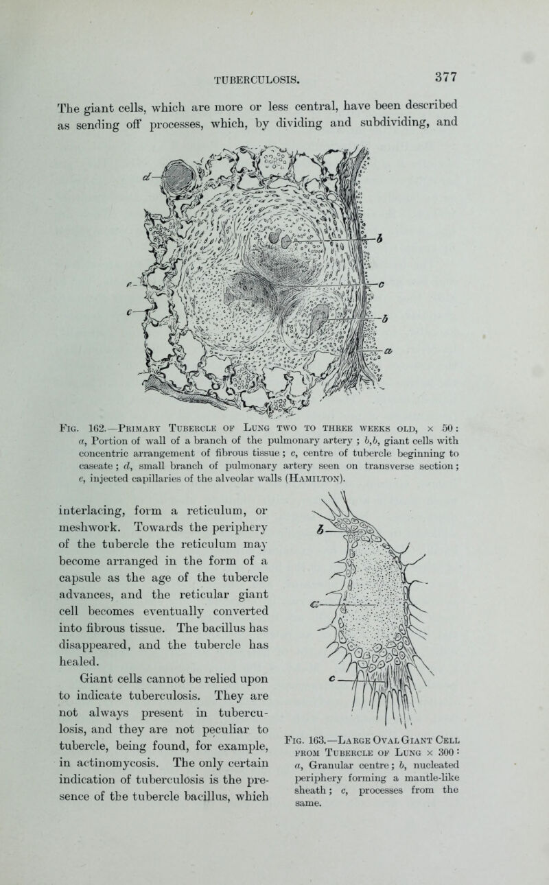 TUBERCULOSIS. The giant cells, which are more or less central, have been described as sending off processes, which, by dividing and subdividing, and Fig. 162.—Primary Tubercle of Lung two to three weeks old, x 50: a, Portion of wall of a branch of the pulmonary artery ; 6,6, giant cells with concentric arrangement of fibrous tissue; c, centre of tubercle beginning to caseate; d, small branch of pulmonary artery seen on transverse section; e, injected capillaries of the alveolar walls (Hamilton). interlacing, form a reticulum, or meshwork. Towards the periphery of the tubercle the reticulum may become arranged in the form of a capsule as the age of the tubercle advances, and the reticular giant cell becomes eventually converted into fibrous tissue. The bacillus has disappeared, and the tubercle has healed. Giant cells cannot be relied upon to indicate tuberculosis. They are not always present in tubercu- losis, and they are not peculiar to tubercle, being found, for example, in actinomycosis. The only certain indication of tuberculosis is the pre- sence of the tubercle bacillus, which Fig. 163.—Large Oval Giant Cell from Tubercle of Lung x 300 : a, Granular centre; 6, nucleated periphery forming a mantle-like sheath; c, processes from the same.