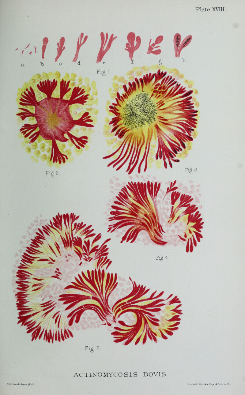 Fig 5. ACTINOMYCOSIS BOVIS E.M. Creoles hank fecit. Vincent Broolca.Bay A(Son,Jath.