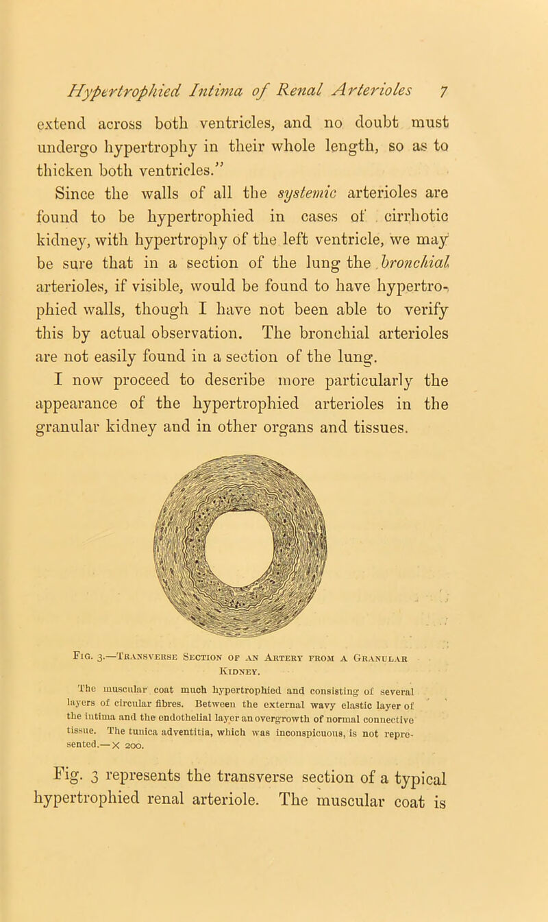 extend across both ventricles, and no doubt must undergo hypertrophy in their whole length, so as to thicken both ventricles.” Since the walls of all the systemic arterioles are found to be hypertrophied in cases of cirrhotic kidney, with hypertrophy of the left ventricle, we may be sure that in a section of the lung the , bronchial arterioles, if visible, would be found to have hypertro-, phied walls, though I have not been able to verify this by actual observation. The bronchial arterioles are not easily found in a section of the lung. I now proceed to describe more particularly the appearance of the hypertrophied arterioles in the granular kidney and in other organs and tissues. Fig. 3.—Transverse Section of an Artery from a Granul.vr Kidney. The muscular coat much hypertrophied and consisting of several layers of circular fibres. Between the external wavy elastic layer of the intima and the endothelial layer an overgrowth of normal connective tissue. The tunica adventitia, which was inconspicuous, is not repre- sented.— X 200. Fig. 3 represents the transverse section of a typical hypertrophied renal arteriole. The muscular coat is