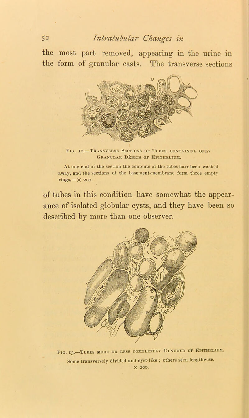 the most part removed, appearing in the urine in the form of granular casts. The transverse sections Fig. 12.—Tbansveuse Sections of Tubes, containing onev Granular Debris of Epithelium. At one end of the section the contents of the tubes have been washed away, and the sections of the basement-membrane form three empty rings,— X 200. of tubes in this condition have somewhat the appear- ance of isolated globular cysts, and they have been so described by more than one observer. Fig. 13. Tubes more or less completely Denuded of Epithelium. Some transversely divided and cyst-like ; others seen lengthwise. X 200.