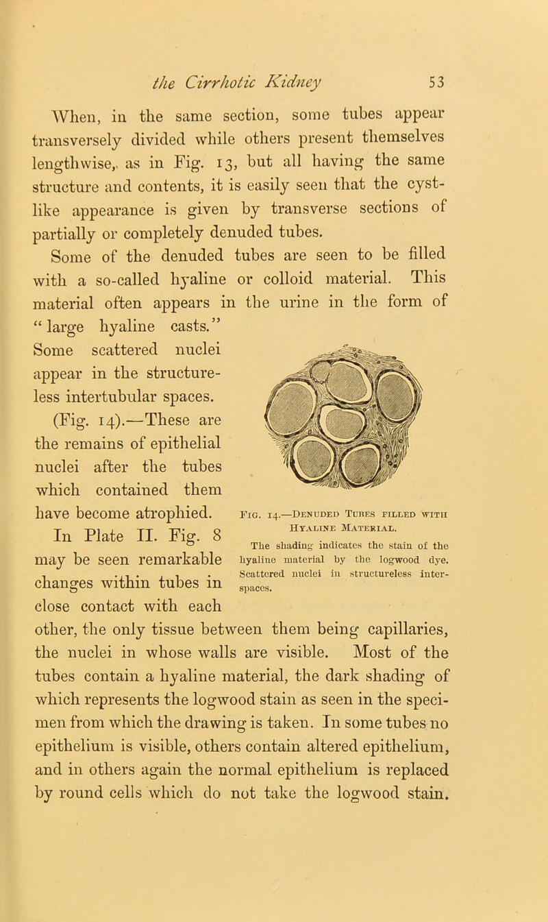 When, in the same section, some tubes appear transversely divided while others present themselves lengthwise,, as in Fig. 13, but all having the same structure and contents, it is easily seen that the cyst- like appearance is given by transverse sections of partially or completely denuded tubes. Some of the denuded tubes are seen to be filled with a so-called hyaline or colloid material. This material often appears in the urine in the form of “large hyaline casts.” Some scattered nuclei appear in the structure- less intertubular spaces. (Fig. 14).—These are the remains of epithelial nuclei after the tubes which contained them have become atrophied. In Plate II. Fig. 8 may be seen remarkable changes within tubes in close contact with each other, the only tissue between them being capillaries, the nuclei in whose walls are visible. Most of the tubes contain a hyaline material, the dark shading of which represents the logwood stain as seen in the speci- men from which the drawing is taken. In some tubes no epithelium is visible, others contain altered epithelium, and in others again the normal epithelium is replaced by round cells which do not take the logwood stain. Fic. 14.—Denuded Tubes filled with Hyaline Material. Tlie shadint;- indicates the stain of the hyaline material by the logwood dye. Scattered nuclei in structureless inter- spaces.