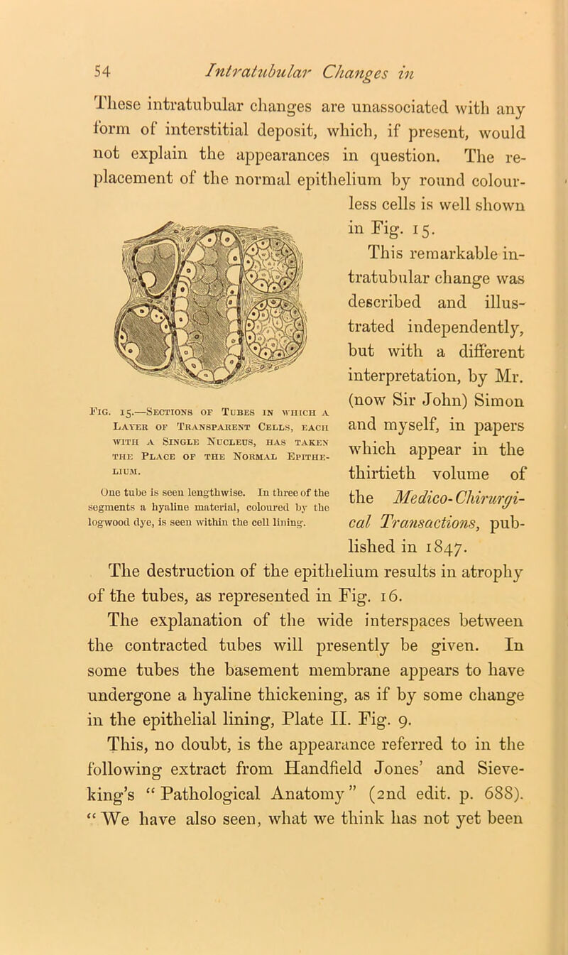 These intratiibular changes are unassociated with any form of interstitial deposit, which, if present, would not explain the appearances in question. The re- placement of the normal epithelium by round colour- less cells is well shown in Fig. 15. This remarkable in- tratubular change was described and illus- trated independently, but with a different interpretation, by Mr. (now Sir John) Simon and myself, in papers which appear in the thirtieth volume of the Medico- Cliirurgi- cal Transactions, pub- lished in 1847. The destruction of the epithelium results in atrophy of the tubes, as represented in Fig. 16. The explanation of the wide interspaces between the contracted tubes will presently be given. In some tubes the basement membrane appears to have undergone a hyaline thickening, as if by some change in the epithelial lining, Plate II. Fig. 9. This, no doubt, is the appearance referred to in the following extract from Handfield Jones’ and Sieve- king’s “Pathological Anatomy” (2nd edit. p. 688). “We have also seen, what we think has not }'’et been Fig. 15.—Sections of Tubes in wincH a Layer of Tr.vnsparent Cells, each WITH A Single Nucleus, has taken THE Place of the Norm.yl Epithe- lium. One tube is seen lengthwise. In three of the segments a hyaline material, coloured by the logwood dye, is seen within the cell lining.
