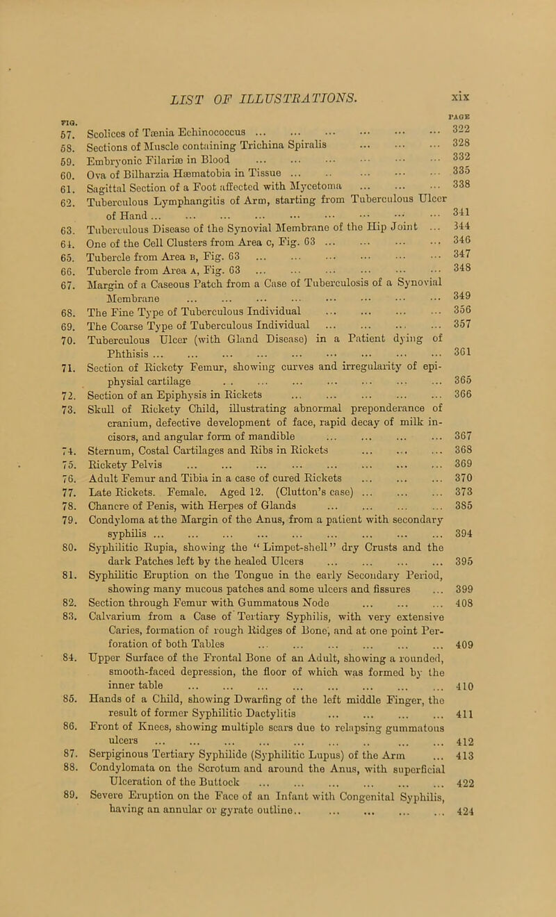 no. 57. 68. 69. 60. 61. 62. 63. 64. 65. 66. 67. 68. 69. 70. 71. 72. 73. 74. 75. 76. 77. 78. 79. 80. 81. 82. 83. 84. 85. 86. 87. 88. 89. PAGE Scoliccs of Taenia Echinococcus Sections of Muscle containing Trichina Spiralis Etnhryonic Filariao in Blood Ova of Bilharzia Haomatohia in Tissue Sagittal Section of a Foot affected with Mycetoma Tuberculous Lymphangitis of Arm, starting from Tuberculous Ulcer of Hand... Tuberculous Disease of the Synovial Membrane of the Hip Joint ... One of the Cell Clusters from Area c, Fig. 63 Tubercle from Area B, Fig. 63 Tubercle from Ai'ea A, Fig. 63 Margin of a Caseous Patch from a Case of Tuberculosis of a Synovial Membrane ... ... ... ... The Fine Type of Tuberculous Individual The Coarse Type of Tuberculous Individual Tuberculous Ulcer (with Gland Disease) in a Patient dying of Phthisis Section of Eickety Femur, showing curves and irregularity of epi- physial cartilage Section of an Epiphysis in Pickets Skull of Eickety Child, illustrating abnormal preponderance of cranium, defective development of face, rapid decay of milk in- cisors, and angular form of mandible Sternum, Costal Cartilages and Eibs in Pickets Eickety Pelvis Adult Femur and Tibia in a case of cured Pickets Late Pickets. Female. Aged 12. (Clutton’s case) ... Chancre of Penis, with Herpes of Glands Condyloma at the Margin of the Anus, from a patient with secondary syphilis Syphilitic Pupia, showing the “ Limpet-shell ” dry Crusts and the dark Patches left by the healed Ulcers Syphilitic Eruption on the Tongue in the early Secondary Period, showing many mucous patches and some ulcers and fissures Section through Femur with Gummatous Node Calvarium from a Case of Teitiary Syphilis, with very extensive Caries, formation of rough Pidges of Bone) and at one point Per- foration of both Tables Upper Sui-face of the Frontal Bone of an Adult, showing a rounded, smooth-faced depression, the floor of which was formed by the inner table ... ... Hands of a Child, showing Dwarfing of the left middle Finger, the result of former Syphilitic Dactylitis Front of Knees, showing multiple scars due to relapsing gummatous ulcers Serpiginous Tertiary Syphilide (Syphilitic Lupus) of the Arm Condylomata on the Scrotum and around the Anus, with superficial Ulceration of the Buttock ... ... ... ... Severe Eruption on the Face of an Infant with Congenital Syphilis, having an annular or gyrate outline.. 322 328 332 335 338 341 344 346 347 348 349 356 357 361 365 366 367 368 369 370 373 385 394 395 399 403 409 410 411 412 413 422 424