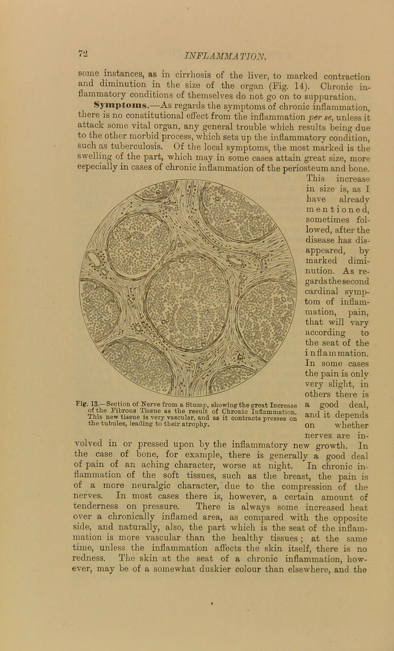 JNFLAMMAT10:S. some instances, as in cirrliosis of the liver, to marked contraction and diminution in tlie size of the organ (Fig. 14). Chronic in- flammatory conditions of themselves do not go on to suppuration. Symptoms.—As regards the symptoms of chronic inflammation, there is no constitutional effect from the inflammation per se, unless it attack some vital organ, any general trouble which results being due to the other morbid process, which sets up the inflammatory condition, such as tuberculosis. Of the local symptoms, the most marked is the swelling of the part, which may in some cases attain great size, more eepecially in cases of chronic inflammation of the periosteum and bone. This increase in size is, as I have already mentioned, sometimes fol- lowed, after the disease has dis- appeared, by marked dimi- nution. As re- gards the second cardinal symp- tom of inflam- mation, pain, that will vary according to the seat of the i nflammation. In some cases the pain is only very slight, in others thei-e is a good deal, and it depends on whether nerves are in- volved in or pressed upon by the inflammatory new growth. In the case of bone, for example, there is generally a good deal of pain of an aching character, worse at night. In chronic in- flammation of the soft tissues, such as the breast, the pain is of a more neuralgic character, due to the compression of the nerves. In most cases there is, however, a certain amount of tenderness on pressure. There is always some increased heat over a chronically inflamed area, as compared with the opposite side, and naturally, also, the part which is the seat of the inflam- mation is more vascular than the healthy tissues; at the same time, unless the inflammation affects the skin itself, there is no redness. The skin at the seat of a chronic inflammation, how- ever, may be of a somewhat duskier colour than elsewhere, and the Fig. 13.—Section of Nerve from a Stump, showing the great Increase of the Fibrous Tissue as the result of Chronic Inflammation. This new tissue is very vascular, and as it contracts presses on the tubules, leading to their atrojiby.