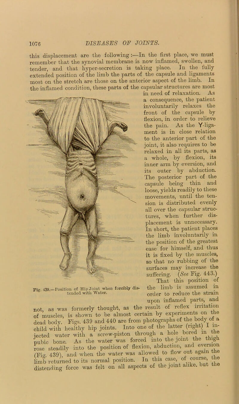 this displacement are the following :—In the first place, we must remember that the synovial membrane is now inflamed, swollen, and tender, and that hyper-secretion is taking place. In the fully extended position of the limb the parts of the capsule and ligaments most on the stretch are those on the anterior aspect of the limb. In the inflamed condition, these parts of the capsular structures are most in need of relaxation. As a consequence, the patient involuntarily relaxes the front of the capsule by flexion, in order to relieve the pain. As the Y-liga- ment is in close relation to the anterior part of the joint, it also requires to be relaxed in all its parts, as a whole, by flexion, its inner arm by eversion, and its outer by abduction. The posterior part of the capsule being thin and loose, yields readily to these movements, until the ten- sion is distributed evenly all over the capsular struc- tures, when further dis- placement is unnecessary. In short, the patient places the limb involuntarily in the position of the greatest ease for himself, and thus it is fixed by the muscles, so that no rubbing of the surfaces may increase the sufi’ering. {See Fig. 443.) That this position of Fig. 439.—Position of Hip Joint when forcibly dis- the limb is assumed in tended with Water. order to reduce the stltim upon inflamed parts, and not, as was formerly thought, as the result of reflex irritation of muscles, is shown to be almost certain by experiments on the dead body. Figs. 439 and 440 are from photographs of the body ot a child with healthy hip joints. Into one of the latter (right) I in- jected water with a screw-piston through a hole bored in the nubic bone. As the water was forced into the .loint the ting rose steadily into tlie position of flexion, abduction, and eversion (Fi'^ 439), and when the water was allowed to flow out again th limb returned to its normal position. In this case, of couree, e distending force was felt on all aspects of the joint alike, but tlie