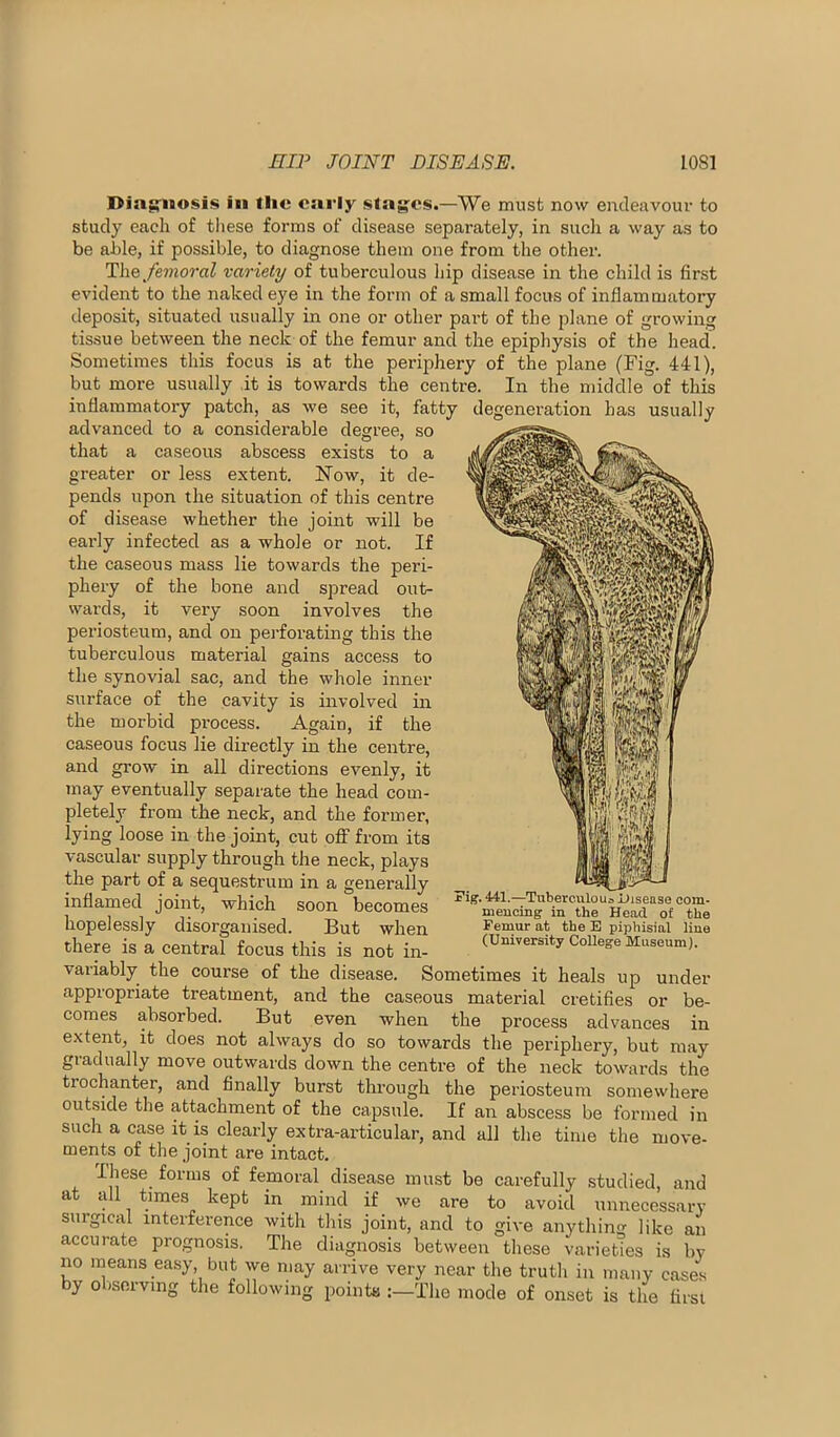 Diag-uosis in flic early stages.—We must now endeavour to study each of these forms of disease separately, in such a way as to be able, if possible, to diagnose them one from the other. T\iq femoral variety of tuberculous hip disease in the child is first evident to the naked eye in the form of a small focus of inflammatory deposit, situated usually in one or other part of the plane of growing tissue between the neck of the femur and the epiphysis of the head. Sometimes this focus is at the periphery of the plane (Fig. 441), but more usually it is towards the centre. In the middle of this inflammatory patch, as we see it, fatty degeneration has usually advanced to a considerable deffree, so that a caseous abscess exists to a greater or less extent. Now, it de- pends upon the situation of this centre of disease whether the joint will be early infected as a whole or not. If the caseous mass lie towards the peri- phery of the bone and spread out- wards, it very soon involves the periosteum, and on perforating this the tuberculous material gains access to the synovial sac, and the whole inner surface of the cavity is involved in the morbid process. Again, if the caseous focus lie directly in the centre, and grow in all directions evenly, it may eventually separate the head com- pletely from the neck, and the former, lying loose in the joint, cut off from its vascular supply through the neck, plays the part of a sequestrum in a generally inflamed joint, which soon becomes hopelessly disorganised. But when there is a central focus this is not in- variably the course of the di.sease. Sometimes it heals up under appropriate treatment, and the caseous material cretifies or be- comes absorbed. But even when the process advances in extent, it does not always do so towards the periphery, but may gradually move outwards down the centre of the neck towards the trochanter, and finally burst through the periosteum somewhere outside the attachment of the capsule. If an abscess be formed in such a case it is clearly extra-articular, and all the time the move- ments of the joint are intact. Ihese forms of femoral disease must be carefully .studied, and at all times kept in mind if we are to avoid unnecessary surgical interference with this joint, and to give anything like an accurate prognosis. The diagnosis between these varieties is by no means easy, but we may arrive very near the truth in many cases by observing the following points :-Tlie mode of onset is the first Fig. 4il.—Tuberculous Disease com- meucing in the Head of the Femur at the E piphisial hue (University College Museum).