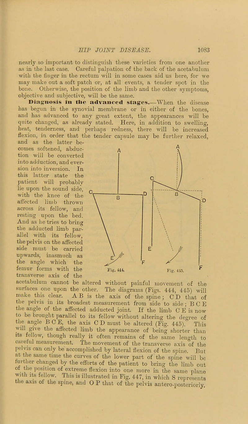 nearly so important to distinguish tliese varieties from one another as in the last case. Careful palpation of the back of the acetabulum with the finger in the rectum Avill in some cases aid us here, for we may make out a soft patch or, at all events, a tender sj)ot in the bone. Otherwise, the position of the limb and the other symptoms, objective and subjective, will be the same. Dinifiiosis in tlie advanced stagfcs.—When the disease has begun in the synovial membrane or in either of the bones, and has advanced to any great extent, the appearances will be quite changed, as ali'eady stated. Here, in addition to swelling, heat, tenderness, and perhaps redness, there will be increased flexion, in order that the tender capsule may be further relaxed, and as the latter be- comes softened, abduc- tion will be converted into adduction, and ever- sion into inversion. In this latter state the patient will probably lie upon the sound side, with the knee of the affected limb thrown across its fellow, and resting upon the bed. And as he tries to bring the adducted limb par- allel with its fellow, the pelvis on the affected side must be carried upwards, inasmuch as the angle which the femur forms with the transverse axis of the Fig. 444. Fig. 445. acetabulum cannot be altered without painful movement of the surfaces one upon the other. The diagrams (Figs. 444, 445) will make this clear. A B is the axis of the spine; C D that of the pelvis in its broadest measurement from side to side; B C E the angle of the affected adducted joint. If the limb C E is now to be brought parallel to its fellow without altering the degree of the angle BCE, the axis C D must be altered (Fig. 445). This will give the affected limb the appearance of being shorter than its fellow, though really it often remains of the same length to careful measurement. The movement of the transverse axis of the pelvis can only be accomplished by lateral flexion of the spine. But at the same time the curves of the lower part of the spine will be further changed by the efforts of the patient to bring the limb out ot the position of extreme flexion into one more in the same plane with its fellow. This is illustrated in Fig. 447, in which S represents the axis of the spine, and O P that of the pelvis antero-posteriorly