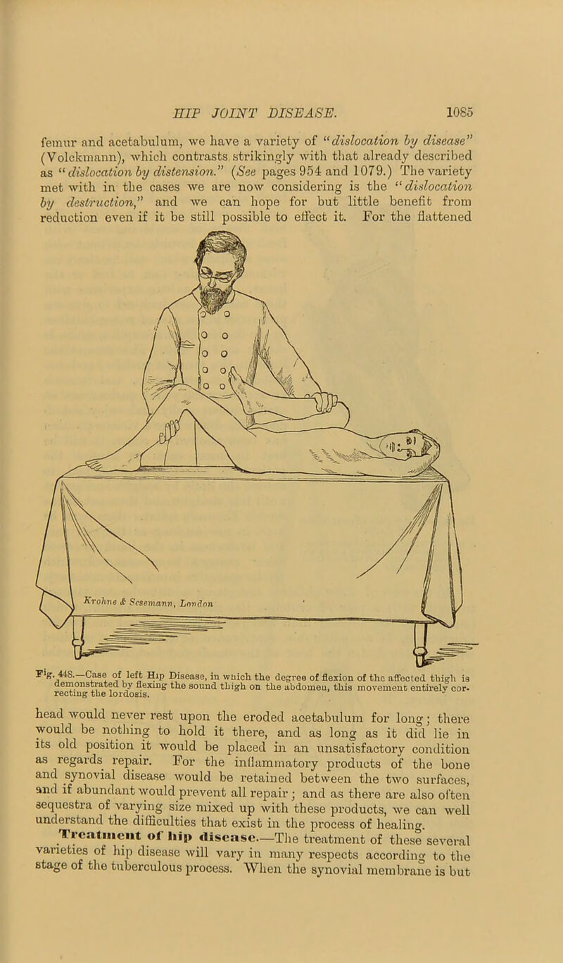 femur and acetabulum, we have a variety of ‘‘dislocation hy disease (Volckmann), which contrasts strikingly with that already described as “ dislocation hy distension. (See pages 954 and 1079.) The variety met with in the cases we are now considering is the “ dislocation by destruction, and we can hope for but little benefit from reduction even if it be still possible to effect it. For the flattened head would never rest upon the eroded acetabulum for long; there would be nothing to hold it there, and as long as it did lie in its old position it would be placed in an unsatisfactory condition as regards^ repair. For the inflammatory products of the bone and synovial disease would be retained between the two surfaces, and if abundant would prevent all repair •, and as there are also often sequestra of varying size mixed up with these products, we can well understand the difficulties that exist in the process of healing. Ti’catment of liig> disease—The treatment of these several varieties of hip disease will vary in many re.spects according to the stage of the tuberculous process. When the synovial membrane is but
