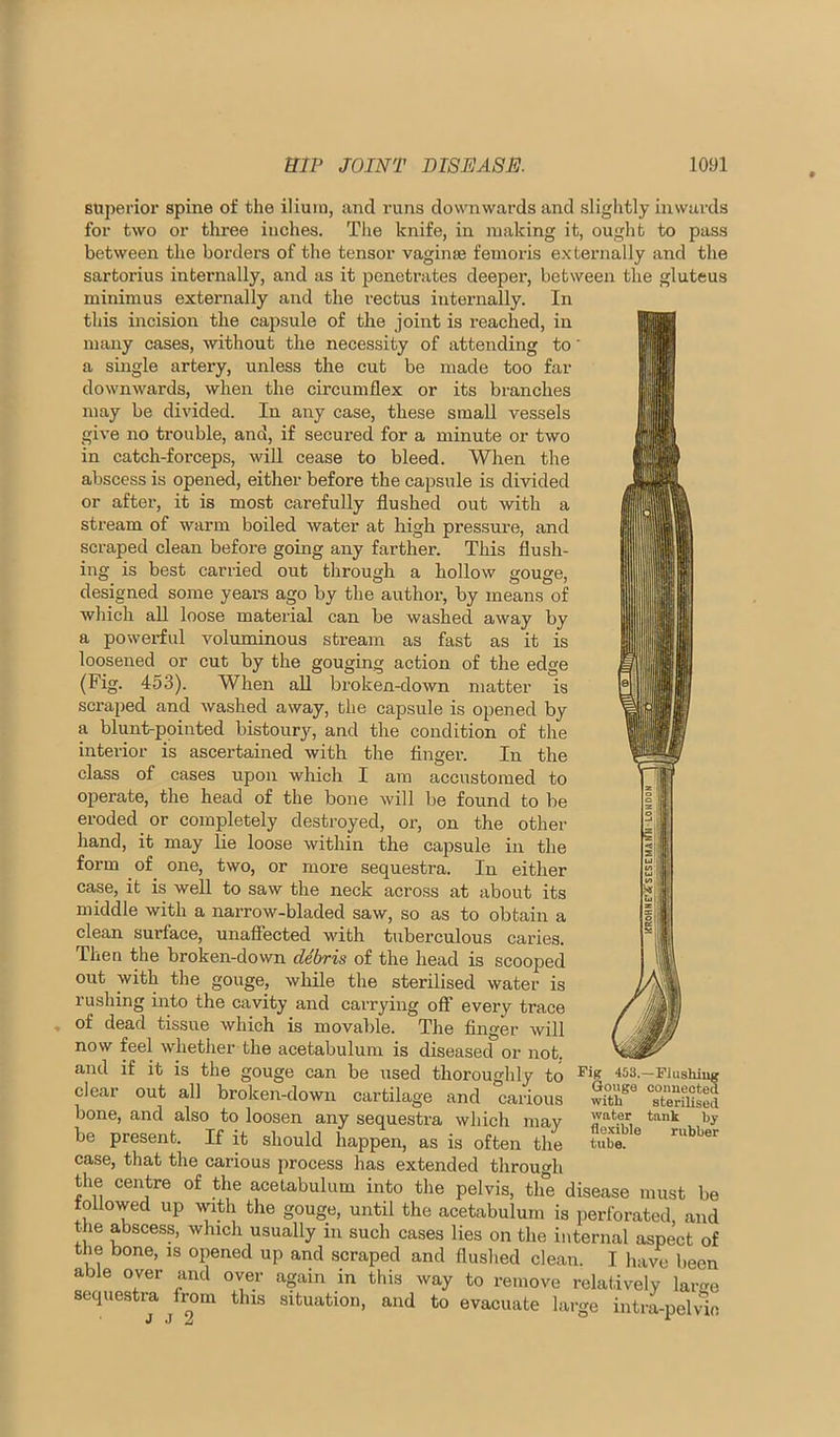 superior spine of the ilium, and runs downwards and slightly inwards for two or three inches. The knife, in making it, ought to pass between the borders of the tensor vaginae femoris externally and the sartoi’ius internally, and as it penetrates deeper, between the gluteus minimus externally and the rectus internally. In this incision the capsule of the joint is reached, in many cases, without the necessity of attending to' a single artery, unless the cut be made too far downwards, when the circumflex or its branches may be divided. In any case, these small vessels give no trouble, and, if secured for a minute or two in catch-forceps, wiU cease to bleed. When the abscess is opened, either before the capsule is divided or after, it is most carefully flushed out with a stream of warm boiled water at high pressure, and scraped clean before going any farther. This flush- ing is best carried out through a hollow gouge, designed some years ago by the author, by means of which aU loose material can be washed away by a powerful voluminous stream as fast as it is loosened or cut by the gouging action of the edge (Fig. 453). When aU broken-down matter is scraped and washed away, the capsule is opened by a blunt-pointed bistoury, and the condition of the interior is ascertained with the Anger. In the class of cases upon which I am accustomed to operate, the head of the bone will be found to be eroded or completely destroyed, or, on the other hand, it may lie loose within the capsule in the form of one, two, or more sequestra. In either case, it is well to saw the neck across at about its middle with a narrow-bladed saw, so as to obtain a clean surface, unaffected with tuberculous caries. Then the broken-down debris of the head is scooped out with the gouge, while the sterilised water is rushing into the cavity and carrying ofi every trace of dead tissue which is movable. The finger will now feel whether the acetabulum is diseased or not. and if it is the gouge can be used thorouglily to clear out all broken-down cartilage and carious bone, and also to loosen any sequestra which may be present. If it should happen, as is often the case, that the carious process has extended through the centre of the acetabulum into the pelvis, the disease must be followed up wth the gouge, until the acetabulum is perforated, and the abscess, which usually in such cases lies on the internal aspect of the bone, is opened up and scraped and flushed clean. I liave been able over and over again in this way to remove relatively lar<ve sequestra from this situation, and to evacuate large iiitiipelvic Fig 453.—Fiushiug Gouge oonuected with sterilised water tank by flexible rubber tube.