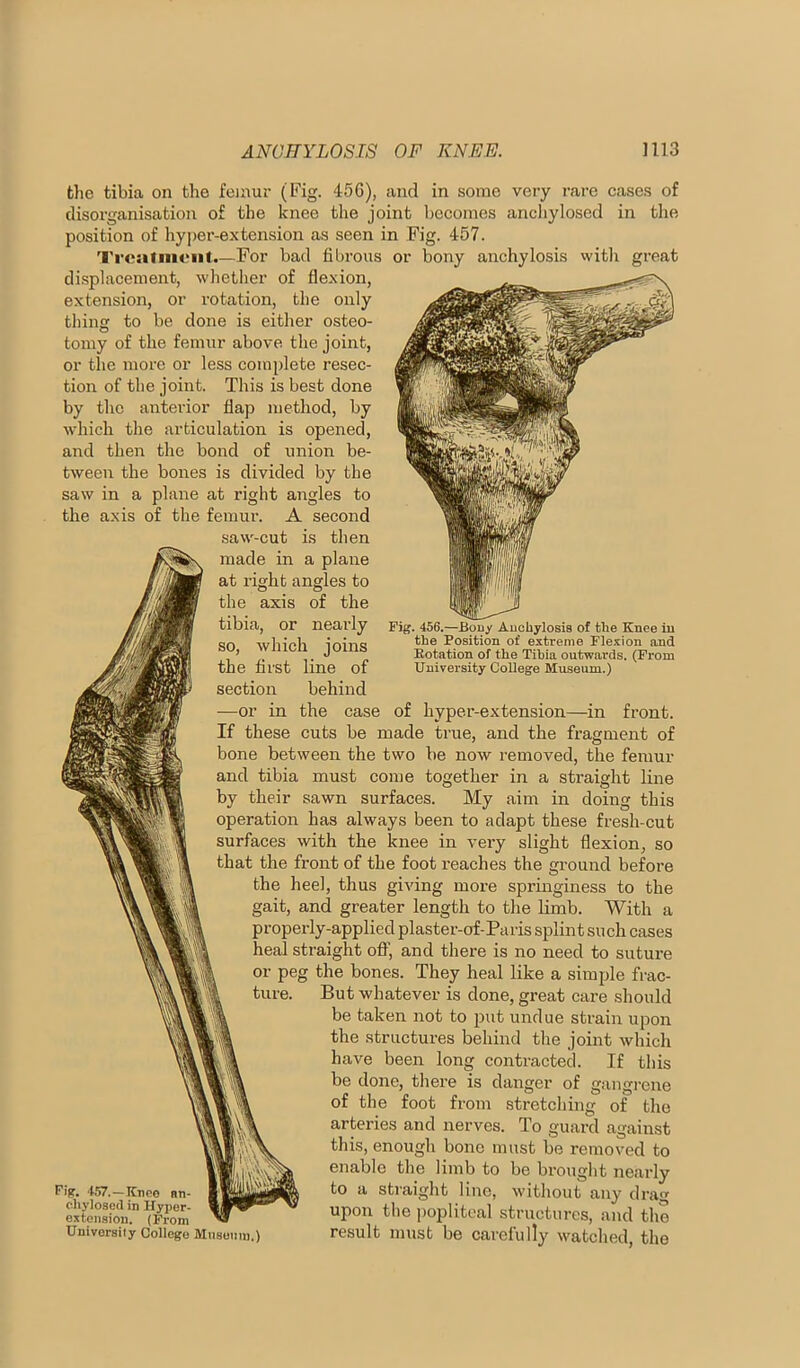 Fig. 456.—Bony Anchylosis of the Knee in the Position of extreme Flexion and Rotation of the Tihia outwards. (From University College Museum.) the tibia on the femur (Fig. 450), and in some very rai-e cases of disorganisation of the knee the joint becomes ancliylosed in the position of hy]>er-extension as seen in Fig. 457. I'reafmeiif.—For bad fibrous or bony anchylosis vvith great displacement, whetlier of flexion, extension, or rotation, the only thing to be done is either osteo- tomy of the femur above the joint, or the more or less complete resec- tion of the joint. This is best done by the anterior flap method, by which the articulation is opened, and then the bond of union be- tAveen the bones is divided by the saw in a plane at right angles to the axis of the femur. A second saw-cut is then made in a plane at right angles to the axis of the tibia, or nearly so, which joins the first line of section behind —or in the case of hyper-extension—in front. If these cuts be made true, and the fragment of bone between the two be now removed, the femur and tibia must come together in a straight line by their sawn surfaces. My aim in doing this operation has always been to adapt these fresh-cut surfaces with the knee in very slight flexion, so that the front of the foot reaches the ground before the heel, thus giving more springiness to the gait, and greater length to the limb. With a properly-applied plaster-of-Paris splint such cases heal straight off, and there is no need to suture or peg the bones. They heal like a simple frac- ture. But whatever is done, great cai’e should be taken not to put undue strain upon the structures behind the joint which have been long contracted. If this be done, there is danger of gangrene of the foot from stretching of the arteries and nerves. To guard against this, enough bone must be removed to enable the limb to be brought nearly to a straight lino, without any drag upon the popliteal structures, and the result must be carefully watched, the Fig. 457.—Knee an- ohylosed in Hyper- extension. (From University College Mnsonni.)