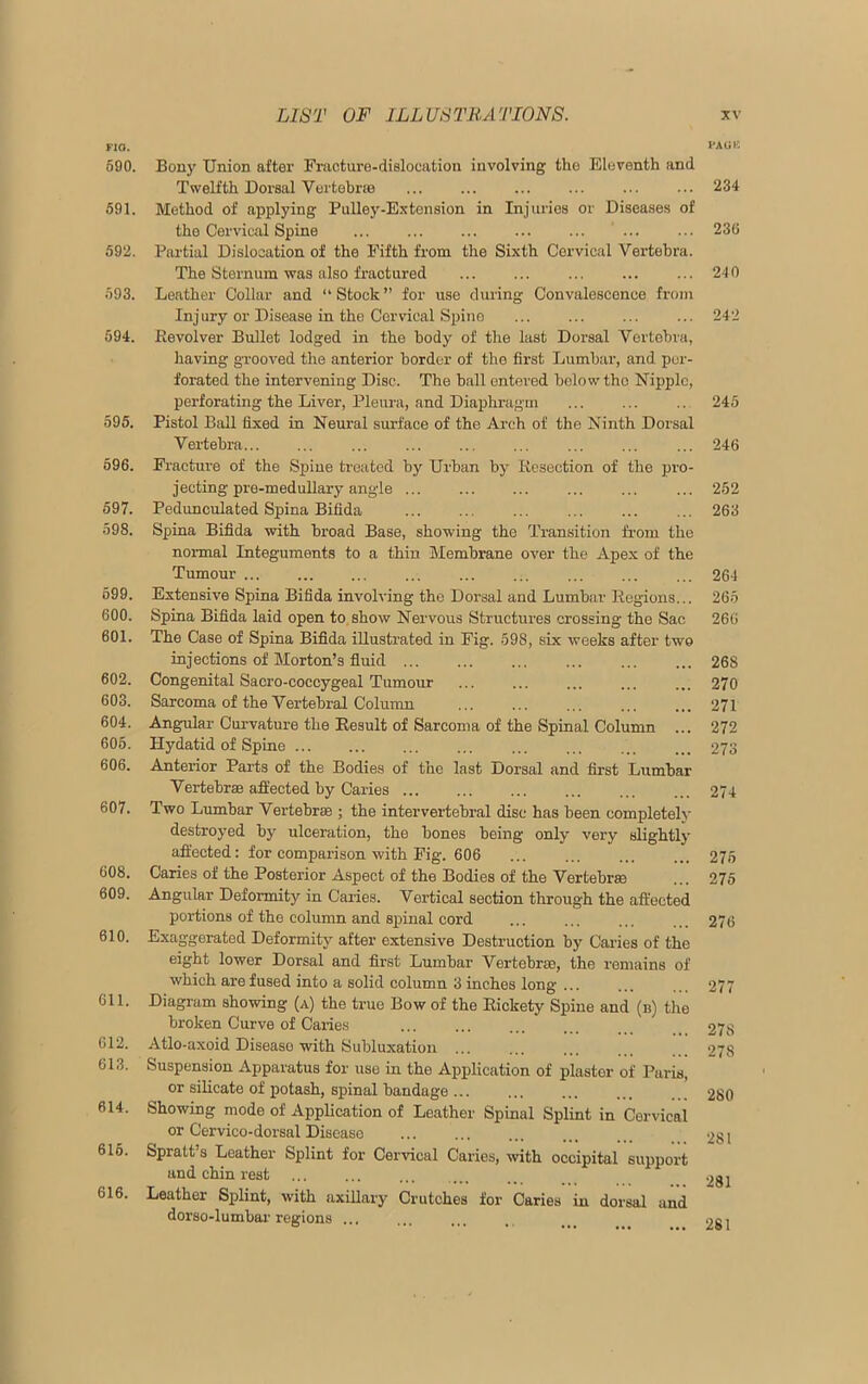 FIO. PAUK 590. Bony Union after Fracture-dislocation involving the Eleventh and Twelfth Dorsal Vertebrae ... ... ... 234 591. Method of applying Pulley-Extension in Injuries or Diseases of the Cervical Spine ... ... 236 592. Partial Dislocation of the Fifth from the Sixth Cervical Vertebra. The Sternum was also fractured ... ... ... ... ... 240 593. Leather Collar and “ Stock ” for use during Convalescence from Injury or Disease in the Cervical Spine ... ... 242 594. Revolver Bullet lodged in the body of the last Dorsal Vertebra, having grooved the anterior border of the first Lumbar, and per- forated the intervening Disc. The ball entered below tho Nipple, perforating the Liver, Pleura, and Diaphragm .. 245 595. Pistol Ball fixed in Neural surface of the Arch of the Ninth Dorsal Vertebra ... ... ... ... ... ... ... 246 596. Fracture of the Spine treated by Urban by Resection of the pro- jecting pre-medullary angle ... 252 597. Pedunculated Spina Bifida 263 598. Spina Bifida with broad Base, showing the Transition from the normal Integuments to a thin Membrane over the Apex of the Tumour 264 699. Extensive Spina Bifida involving the Dorsal and Lumbar Regions... 265 600. Spina Bifida laid open to show Nervous Structures crossing the Sac 260 601. The Case of Spina Bifida illustrated in Fig. 598, six weeks after twm injections of Morton’s fluid 268 602. Congenital Sacro-coccygeal Tumour ... ... ... ... ... 270 603. Sarcoma of the Vertebral Column 271 604. Angular Curvature the Result of Sarcoma of the Spinal Column ... 272 605. Hydatid of Spine ... ... ... ... ... ... ... ... 273 606. Anterior Parts of the Bodies of the last Dorsal and first Lumbar Vertebrae affected by Caries 274 607. Two Lumbar Vertebrae ; the intervertebral disc has been completely destroyed by ulceration, the bones being only very slightly affected: for comparison with Fig. 606 ... ... ... ... 275 608. Caries of the Posterior Aspect of the Bodies of the Vertebrae ... 275 609. Angular Deformity in Caries. Vertical section through the affected portions of the column and spinal cord ... ... ... ... 276 610. Exaggerated Deformity after extensive Destruction by Caries of the eight lower Dorsal and first Lumbar Vertebras, the remains of which are fused into a solid column 3 inches long ... ... 277 611. Diagram showing (a) the true Bow of the Rickety Spine and (b) the broken Curve of Caries ... 278 612. Atlo-axoid Disease with Subluxation 278 613. Suspension Apparatus for use in the Application of plaster of Paris, or silicate of potash, spinal bandage... ... ... ... 280 614. Showing mode of Application of Leather Spinal Splint in Cervical or Cervico-dorsal Disease 281 615. Spratt’s Leather Splint for Cervical Caries, with occipital support and chin rest ... 2gj 616. Leather Splint, with axillary Crutches for Caries in dorsal and dorso-lumbar regions ... ... ... . ... 281