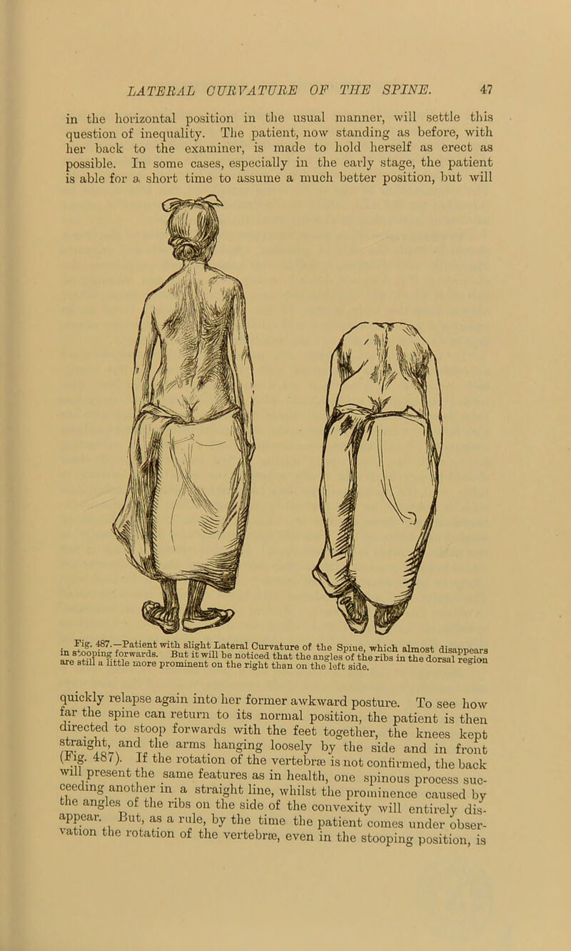 in the horizontal position in the usual manner, will settle this question of inequality. The patient, now standing as before, with her back to the examiner, is made to hold herself as erect as possible. In some cases, especially in the early stage, the patient is able for a short time to assume a much better position, but will • Klg‘ 'l8?.—Patient with slight Lateral Curvature of the Spine, which almost disappears SesHl?lnr A°1rwards- But16 ’P11 be noticed that the angles of the ribs in the dorsal region are still u little more prominent on the right than on the loft side. region quickly relapse again into her former awkward posture. To see how far the spine can return to its normal position, the patient is then directed to stoop forwards with the feet together, the knees kept straight and the arms hanging loosely by the side and in front l .if 487> Jt the station of the vertebral is not confirmed, the back will present the same features as in health, one spinous process suc- ceeding another in a straight line, whilst the prominence caused by the angles of the ribs on the side of the convexity will entirely dis- appear But, as a rule, by the time the patient comes under obser- i ation the rotation of the vertebra, even in the stooping position, is