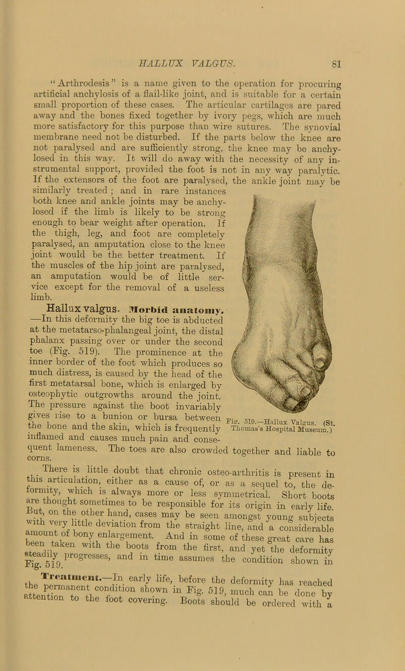 “Arthrodesis” is a name given to the operation for procuring artificial anchylosis of a fiail-like joint, and is suitable for a certain small proportion of these cases. The articular cartilages are pared away and the bones fixed together by ivory pegs, which are much more satisfactory for this purpose than wire sutures. The synovial membrane need not be disturbed. If the parts below the knee are not paralysed and are sufficiently strong, the knee may be anchy- losecl in this way. It will do away with the necessity of any in- strumental support, provided the foot is not in any way paralytic. If the extensors of the foot are paralysed, the ankle joint may be similarly treated ; and in rare instances both knee and ankle joints may be anchy- losed if the limb is likely to be strong enough to bear weight after operation. If the thigh, leg, and foot are completely paralysed, an amputation close to the knee joint would be the better treatment. If the muscles of the hip joint are paralysed, an amputation would be of little ser- vice except for the removal of a useless limb. Hallux valgus. Morbid anatomy. —In this deformity the big toe is abducted at the metatarso-phalangeal joint, the distal phalanx passing over or under the second toe (Fig. 519). The prominence at the inner border of the foot which produces so much distress, is caused by the head of the first metatarsal bone, which is enlarged by osteophytic outgrowths around the joint. The pressure against the boot invariably gives rise to a bunion or bursa between Fi„ the bone and the skin, which is frequently inflamed and causes much pain and conse- quent lameness. The toes are also crowded together and liable to corns. There is little doubt that chronic osteo-arthritis is present in this articulation, either as a cause of, or as a sequel to, the de- tornnty, which is always more or less symmetrical. Short boots are thought sometimes to be responsible for its origin in early life, .but, on the other hand, cases may be seen amongst young subjects :,lsre derti0n *™» line, and a coSsWeS amount of bony enlargement. And in some of these great care has been taken with the boots from the first, and yet “the deformity % 519.Pr°SreSSeS’ in time aSSUnies the ^ndition shown in the^Prearl7 Hfe’ before fche deformity has reached attenSTo tlC°r 7°n °Wn in Fi- 519> much can be done by attention to the loot covering. Boots should be ordered with a - 519.—Hallux Valgus. (St. Tliomas’s Hospital Museum.)