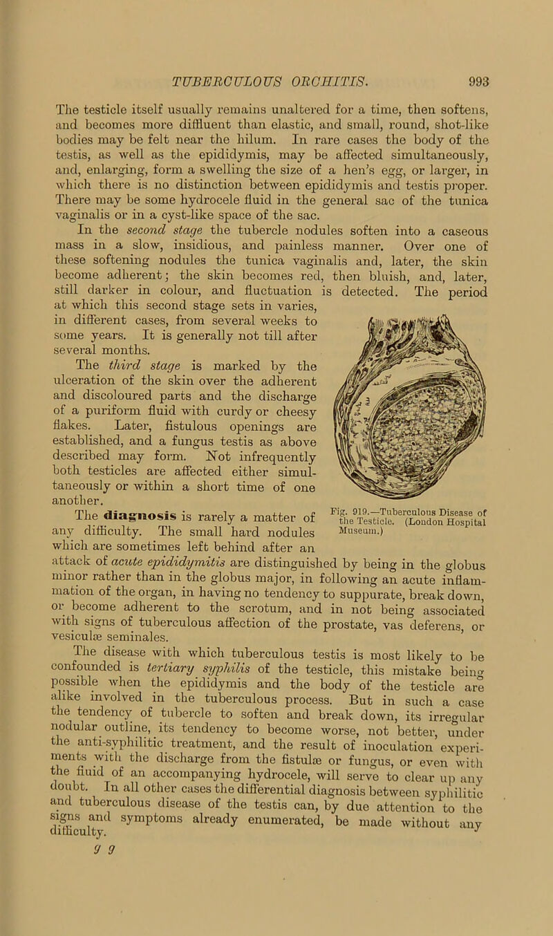 The testicle itself usually remains unaltered for a time, then softens, and becomes more diffluent than elastic, and small, round, shot-like bodies may be felt near the kilum. In rare cases the body of the testis, as well as the epididymis, may be affected simultaneously, and, enlarging, form a swelling the size of a lien’s egg, or larger, in which there is no distinction between epididymis and testis proper. There may be some hydrocele fluid in the general sac of the tunica vaginalis or in a cyst-like space of the sac. In the second stage the tubercle nodules soften into a caseous mass in a slow, insidious, and painless manner. Over one of these softening nodules the tunica vaginalis and, later, the skin become adherent; the skin becomes red, then bluish, and, later, still darker in colour, and fluctuation is detected. The period at which this second stage sets in varies, in different cases, from several weeks to some years. It is generally not till after several months. The third stage is marked by the ulceration of the skin over the adherent and discoloured parts and the discharge of a puriform fluid with curdy or cheesy flakes. Later, fistulous openings are established, and a fungus testis as above described may form. Not infrequently both testicles are affected either simul- taneously or within a short time of one another. The diagnosis is rarely a matter of any difficulty. The small hard nodules which are sometimes left behind after an attack of acute epididymitis are distinguished by being in the globus minor rather than in the globus major, in following an acute inflam- mation of the organ, in having no tendency to suppurate, break down, or become adherent to the scrotum, and in not being associated with signs of tuberculous affection of the prostate, vas deferens, or vesiculte seminales. Fig. 019.—Tuberculous Disease of the Testicle. (London Hospital Museum.) The disease with which tuberculous testis is most likely to be confounded is tertiary syphilis of the testicle, this mistake being possible when the epididymis and the body of the testicle are alike involved in the tuberculous process. But in such a case the tendency of tubercle to soften and break down, its irregular nodular outline, its tendency to become worse, not better, under the anti-syphilitic treatment, and the result of inoculation experi- ments with the discharge from the fistulae or fungus, or even with the fluid of an accompanying hydrocele, will serve to clear up any doubt. In all other cases the differential diagnosis between syphilitic and tuberculous disease of the testis can, by due attention to the dflhculty1 Sympt°ms alreadT enumerated, be made without any 9 9