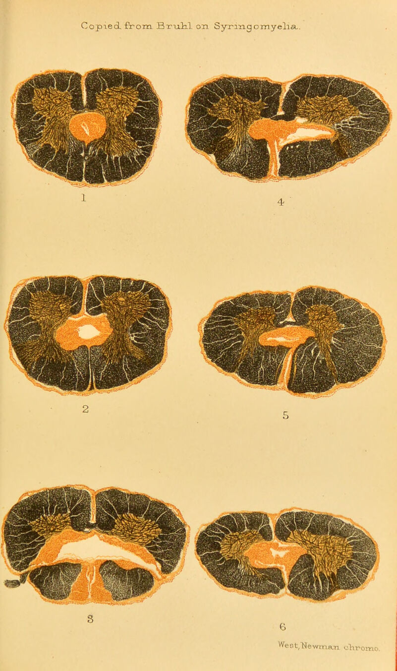 Copied, from Brixlil on Syringomyelia. Weot/Newman chromo.