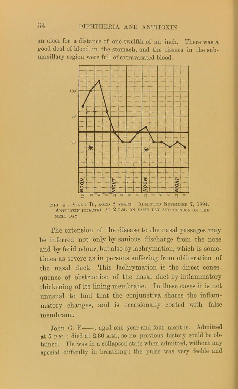 an ulcer for a distance of one-twelfth of an inch. There was a good deal of blood in the stomach, and the tissues in the sub- maxillary region were full of extravasated blood. Fig. 4.—Vinny B., aged 8 teaks. Admitted November 7, 1894. Antitoxin injected at 2 p.m. on same day and at noon on the NEXT DAY The extension of the disease to the nasal passages may be inferred not only by sanious discharge from the nose and by fetid odour, hut also by lachrymation, which is some- times as severe as in persons suffering from obliteration of the nasal duct. This lachrymation is the direct conse- quence of obstruction of the nasal duct by inflammatory thickening of its lining membrane. In these cases it is not unusual to find that the conjunctiva shares the inflam- matory changes, and is occasionally coated with false membrane. John G. E , aged one year and four months. Admitted at 5 p.m. ; died at 2.30 a.m., so no previous history could be ob- tained. He was in a collapsed state when admitted, without any special difficulty in breathing; the pulse Avas very feeble and