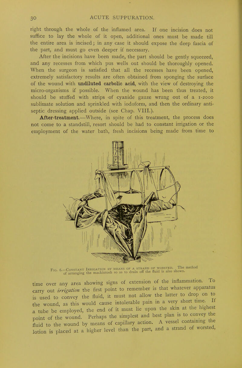 right through the whole of the inflamed area. If one incision does not suffice to lay the whole of it open, additional ones must be made till the entire area is incised; in any case it should expose the deep fascia of the part, and must go even deeper if necessary. After the incisions have been made, the part should be gently squeezed, and any recesses from which pus wells out should be thoroughly opened. When the surgeon is satisfied that all the recesses have been opened, extremely satisfactory results are often obtained from sponging the surface of the wound with undiluted carbolic acid, with the view of destroying the micro-organisms if possible. When the wound has been thus treated, it should be stuffed with strips of cyanide gauze wrung out of a 1-2000 sublimate solution and sprinkled with iodoform, and then the ordinary anti- septic dressing applied outside (see Chap. VIII.). After-treatment.—Where, in spite of this treatment, the process does not come to a standstill, resort should be had to constant irrigation or the employment of the water bath, fresh incisions being made from time to Flr 6 Constant Irrigation by means of a strand of worsted. The method ' of arranging the mackintosh so as to drain off the fluid is also shown. time over any area showing signs of extension of the inflammation. To carry out irrigation the first point to remember is that whatever apparatus is used to convey the fluid, it must not allow the latter to drop on to the wound, as this would cause intolerable pain in a very short time. If a tube be employed, the end of it must lie upon the skin at the highest point of the wound. Perhaps the simplest and best plan is to convey the fluid to the wound by means of capillary action. A vessel containing the lotion is placed at a higher level than the part, and a strand of worsted,