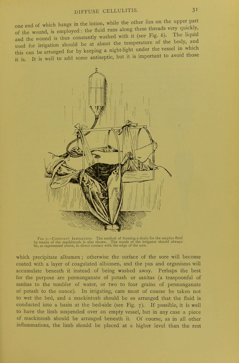 one end of which hangs in the lotion, while the other lies on the upper part r.he wound, is employed : the fluid runs along these threads veryM and the wound is thus constantly washed with it (see Fig. ). used for irrigation should be at about the temperature of the body, and this can be arranged for by keeping a night-light under the vessel in tv tci it is. It is well to add some antiseptic, but it is important to avoid those Fig. 7.—Constant Irrigation. The method of forming a drain for the surplus fluid by means of the mackintosh is also shown. The nozzle of the irrigator should always lie, as represented above, in direct contact with the edge of the sore. which precipitate albumen; otherwise the surface of the sore will become coated with a layer of coagulated albumen, and the pus and organisms will accumulate beneath it instead of being washed away. Perhaps the best for the purpose are permanganate of potash or sanitas (a teaspoonful of sanitas to the tumbler of water, or two to four grains of permanganate of potash to the ounce). In irrigating, care must of course be taken not to wet the bed, and a mackintosh should be so arranged that the fluid is conducted into a basin at the bed-side (see Fig. 7). If possible, it is well to have the limb suspended over an empty vessel, but in any case a piece of mackintosh should be arranged beneath it. Of course, as in all other inflammations, the limb should be placed at a higher level than the rest